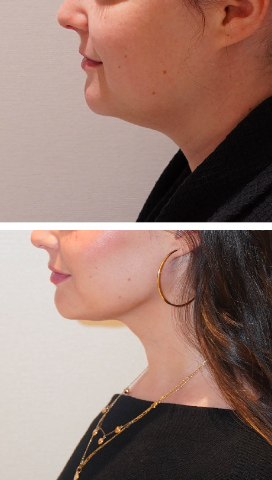 Side-by-side Chin Liposuction Photos show a woman's profile before and after her procedure, highlighting a more defined jawline and added accessories in the after image.