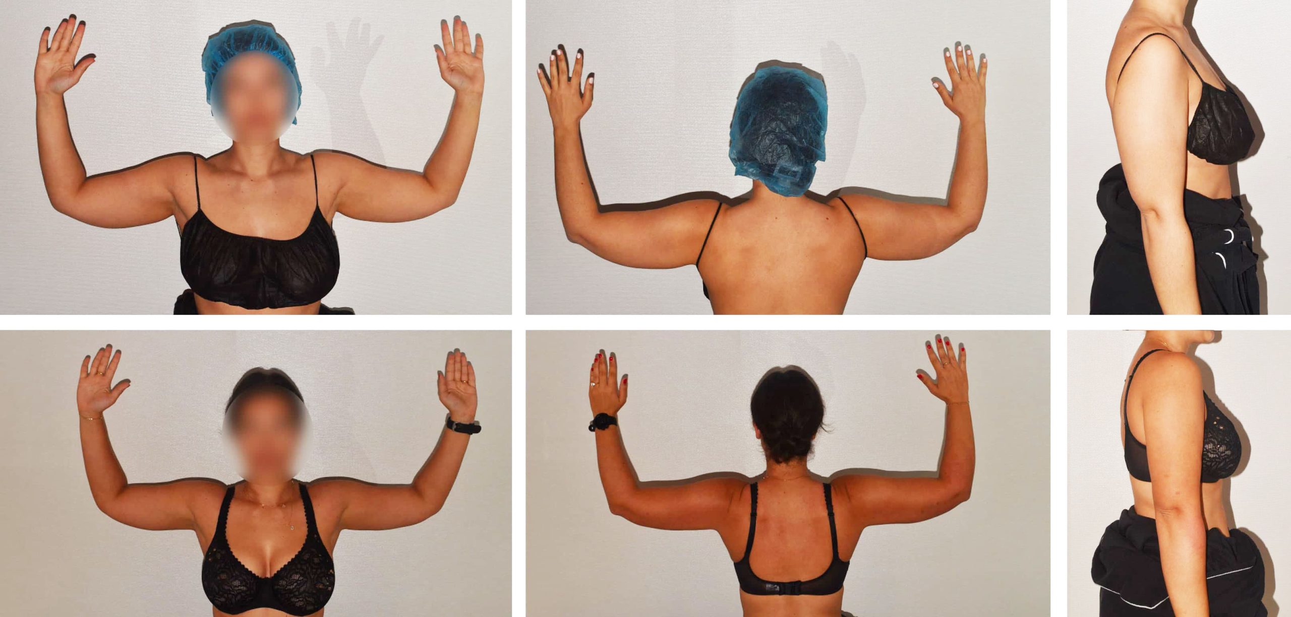 Two side-by-side sets of before and after photos show a woman in a black bra raising her arms, with front, back, and side views taken against a plain background—highlighting impressive Arm liposuction results in this photo gallery.