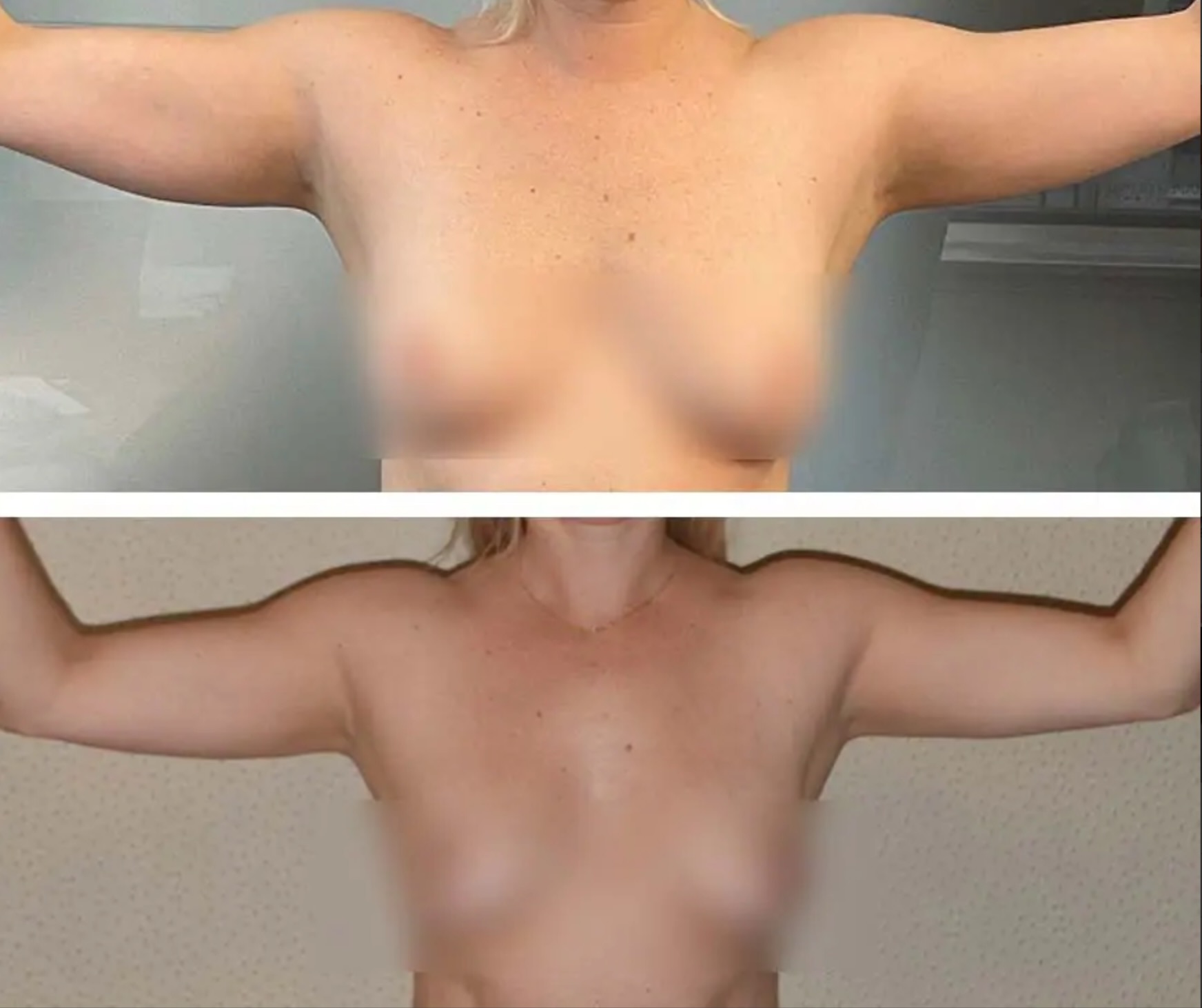 Two side-by-side images from an Arm liposuction photo gallery show a woman with arms raised before and after the procedure, highlighting reduced arm sagging in the second photo.
