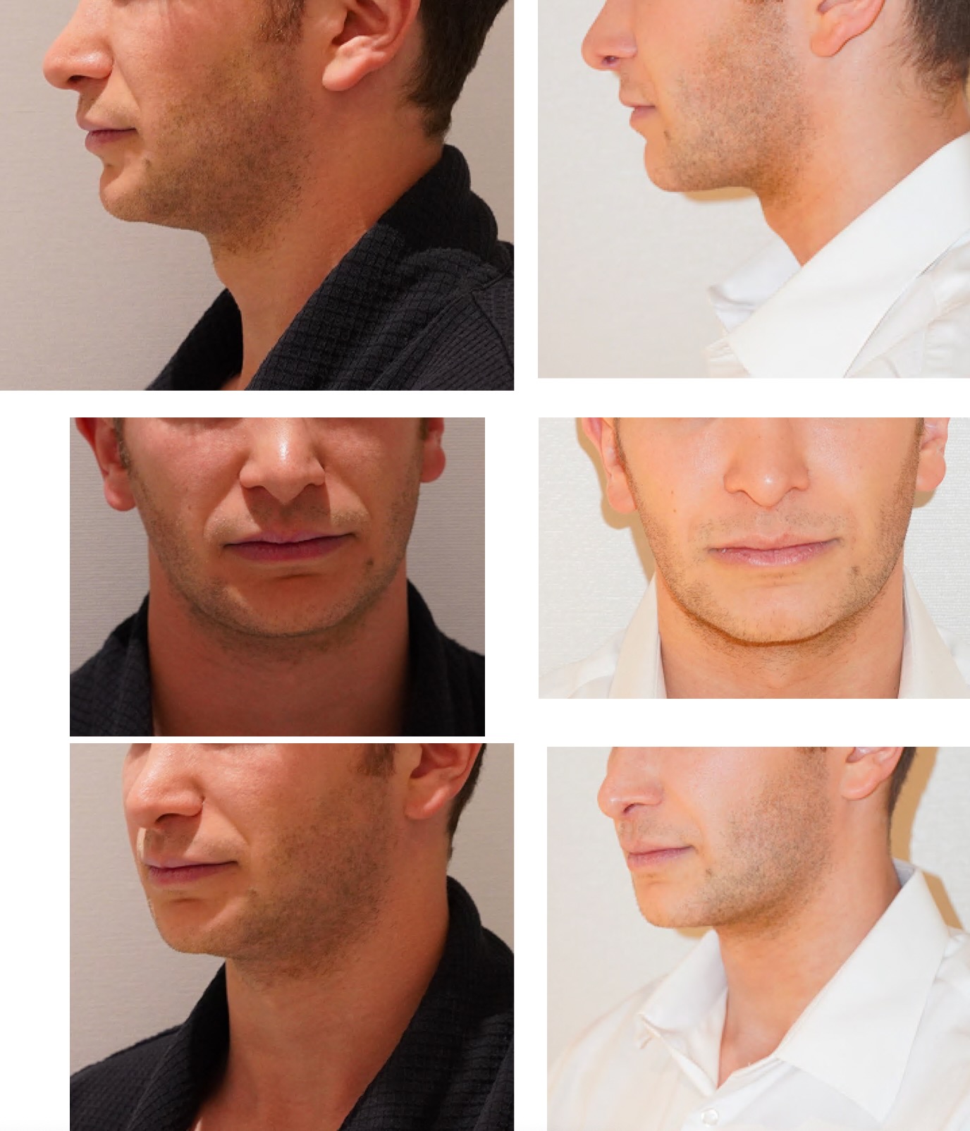 Side-by-side comparison of a man's lower face before (left) and after (right) chin liposuction, showing changes in jawline and chin definition from different angles in these chin liposuction photos.
