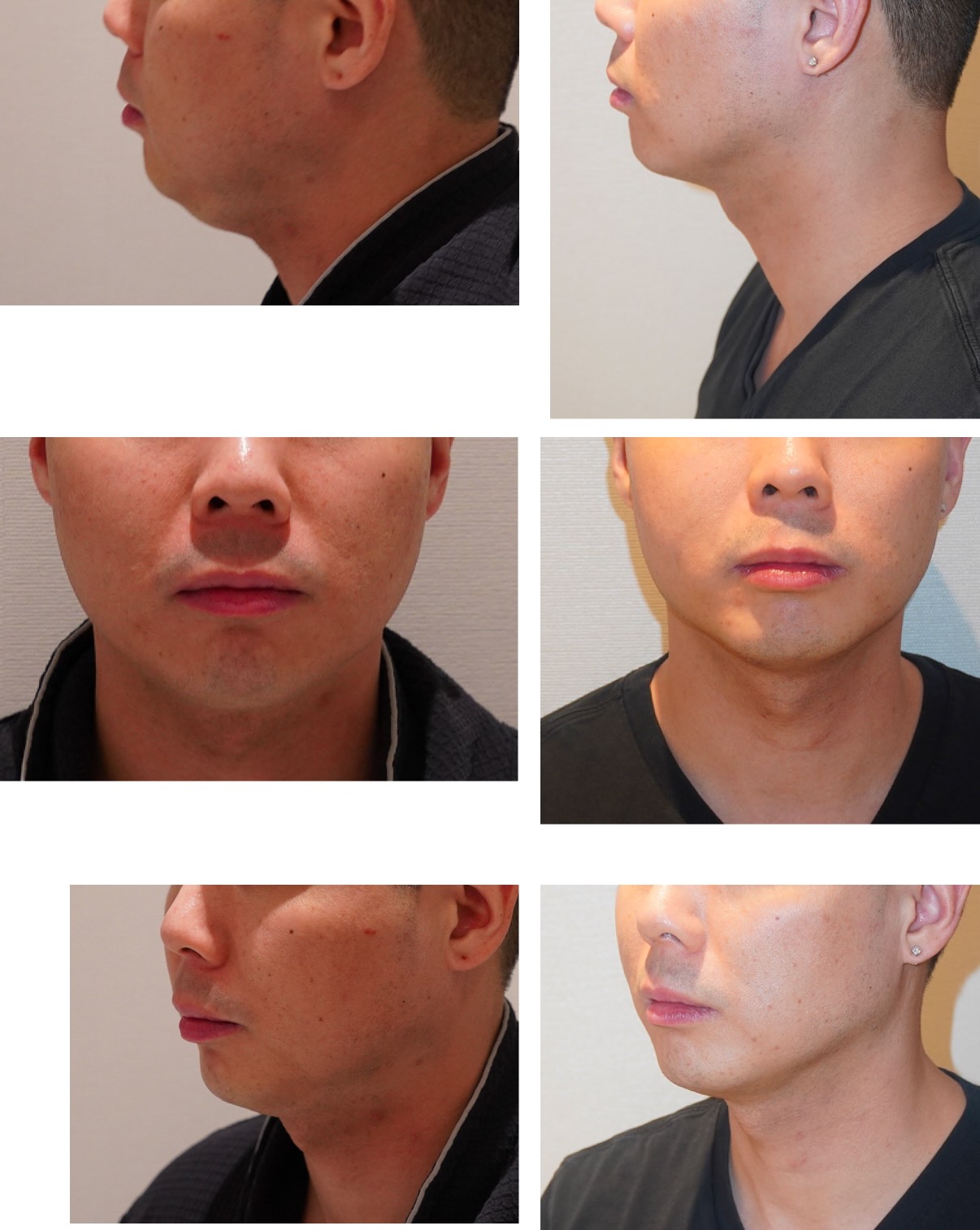 Side-by-side chin liposuction photos of a man’s lower face before (left) and after (right) the procedure, shown from multiple angles including profile and front views.
