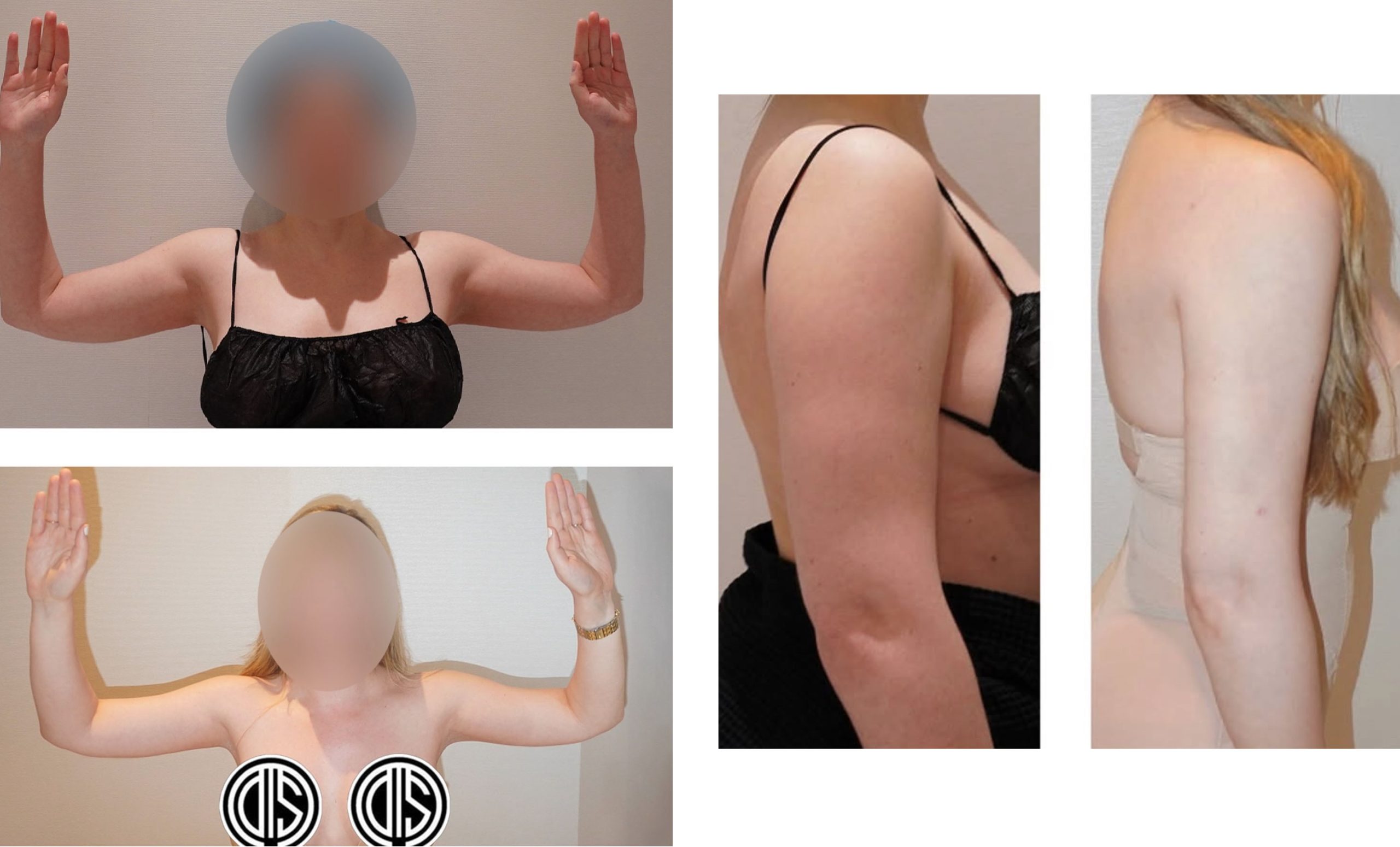 Four side-by-side before and after photos from our Photo Gallery show a woman with her face blurred, highlighting arm and upper body changes from different angles following Arm Liposuction.