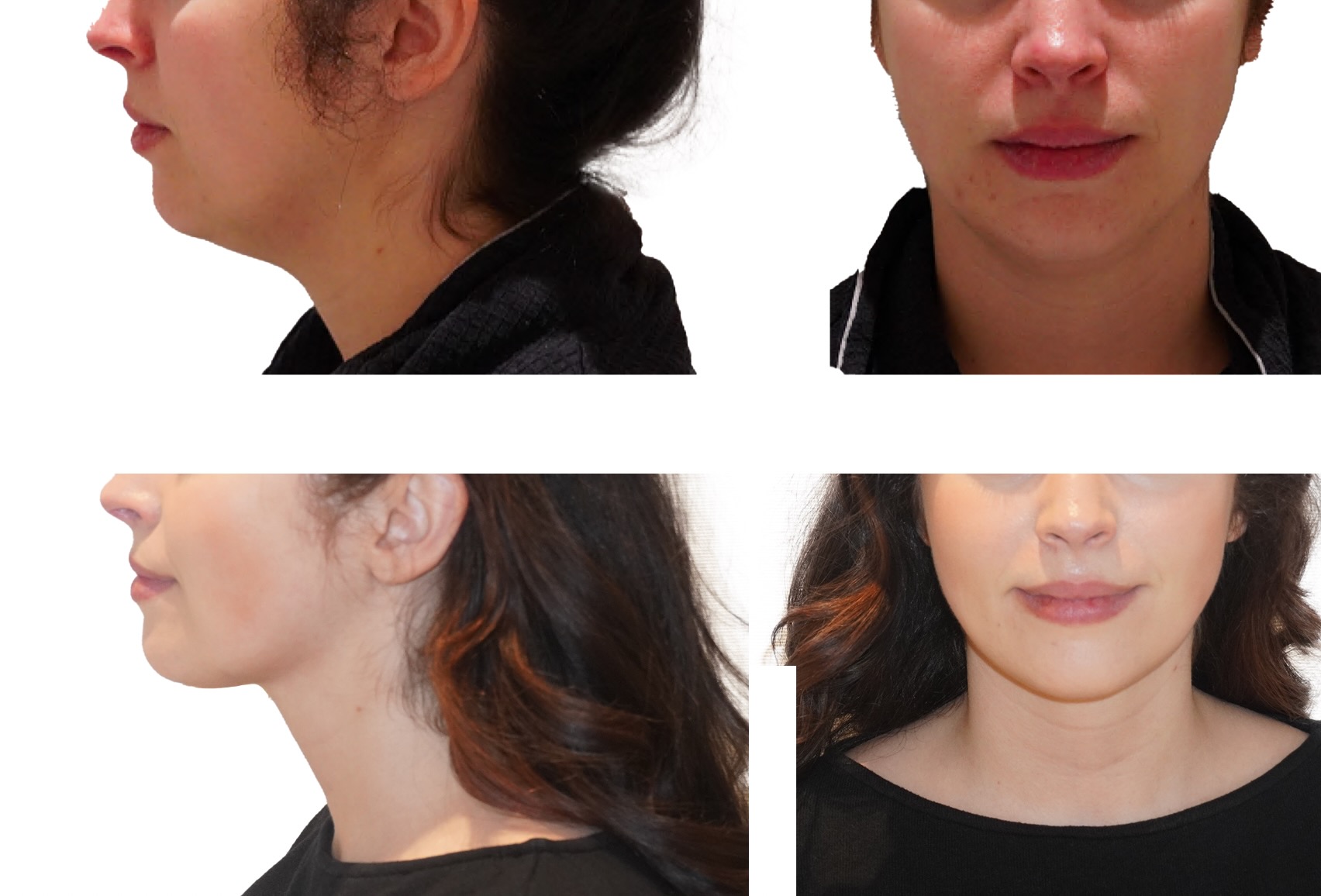 Before-and-after photos of a woman highlight changes in chin, jawline, and neck contours from side and front angles, showcasing Chin Liposuction results.