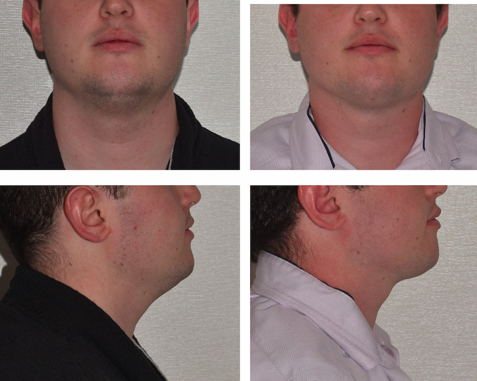 Four close-up chin liposuction photos showing a person's lower face and neck, with front and side views, before and after a visible change in neck and jawline appearance.