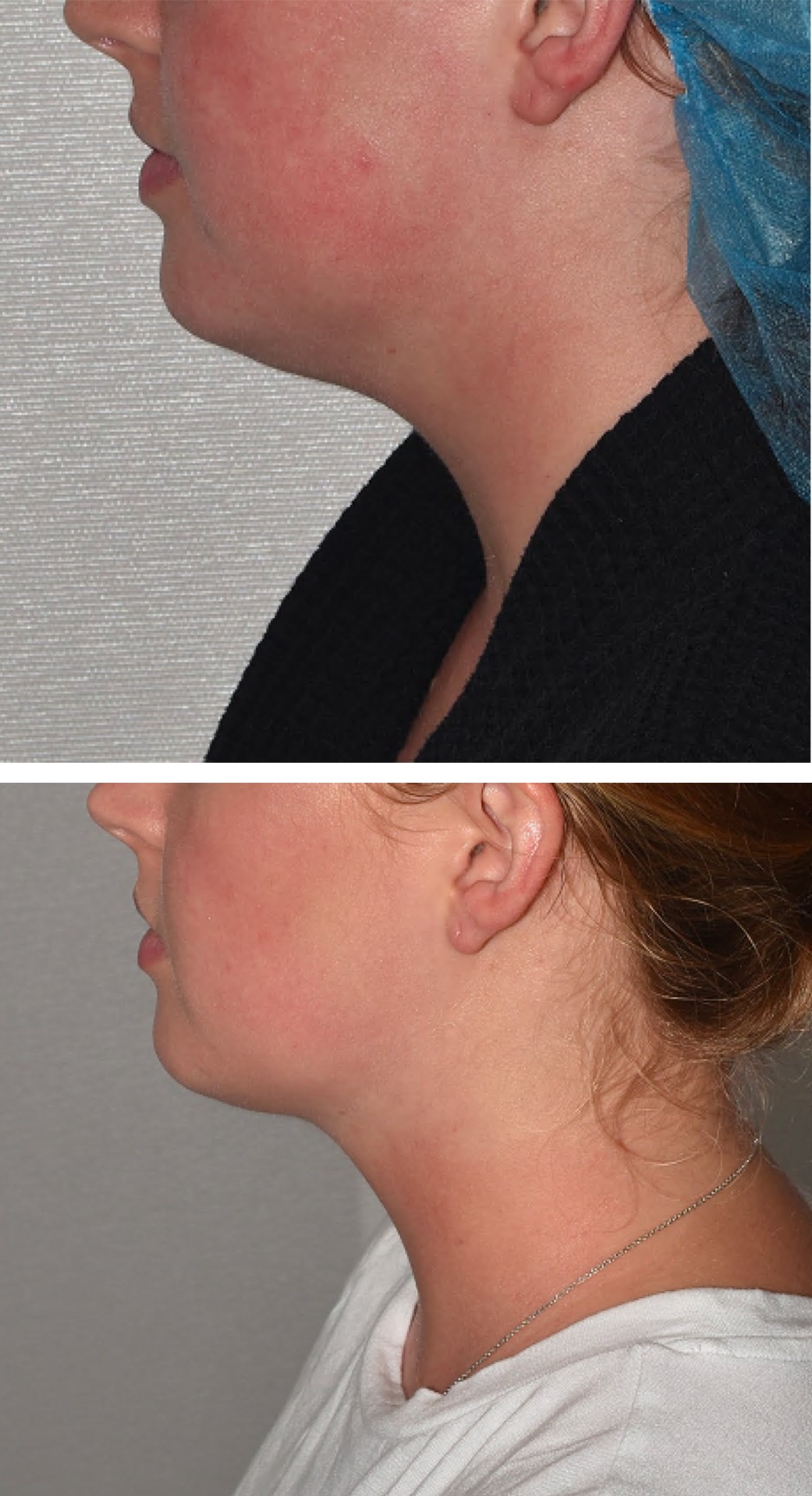 Side-by-side comparison of a woman's jawline and neck in chin liposuction before and after photos, highlighting a more defined contour in the after image.