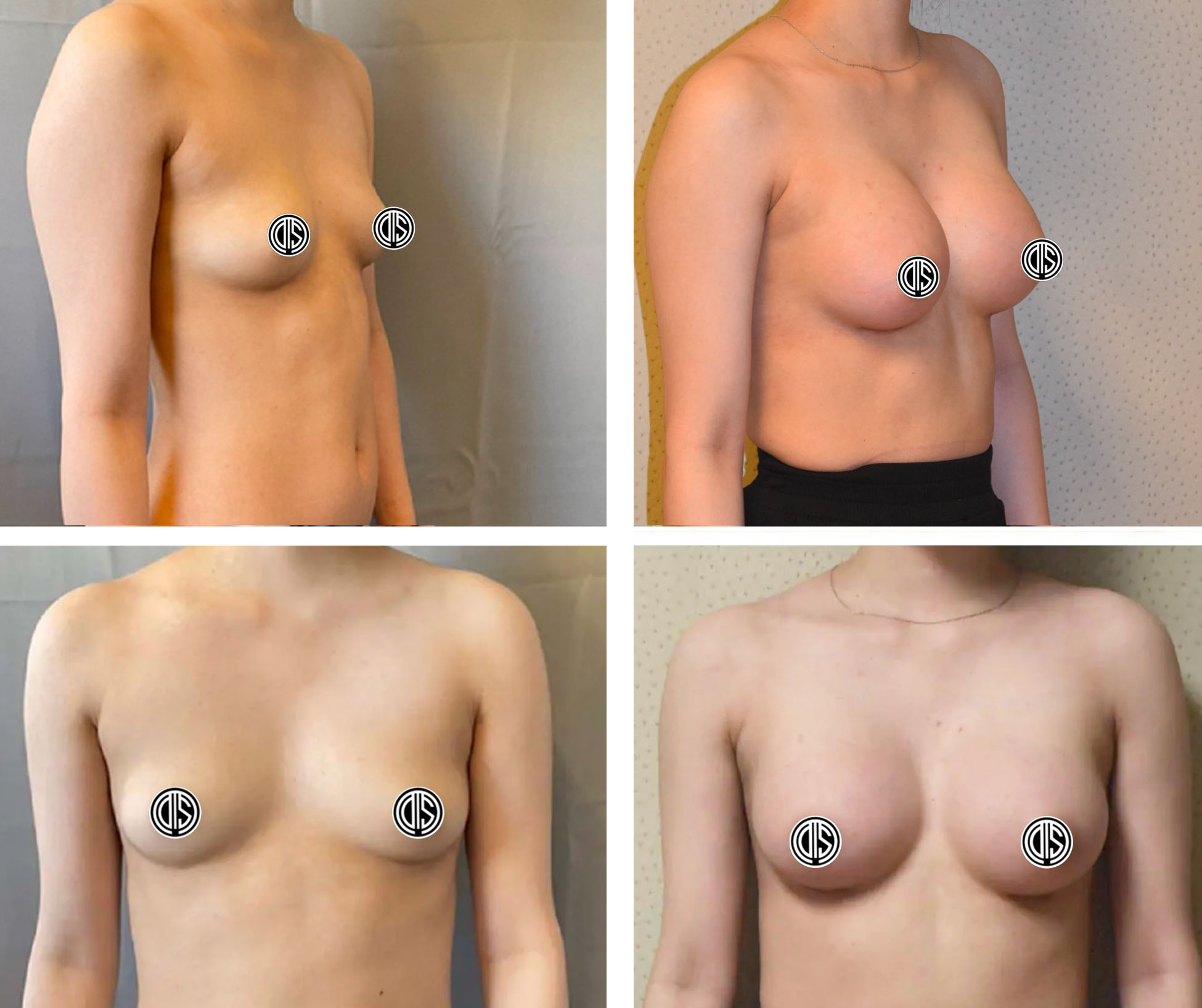 Images show four women from the chest up in before-and-after Breast Augmentation comparisons; nipples are covered with graphic symbols for modesty.