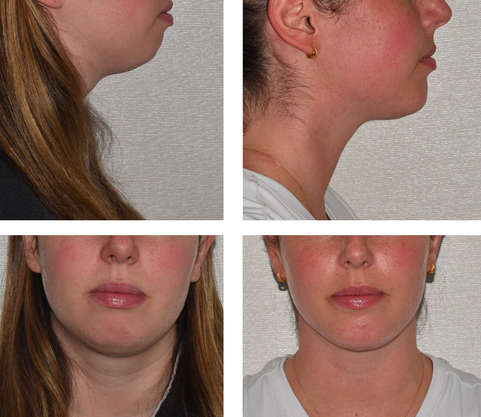 Four photos show side and front views of a woman's lower face and neck before and after chin liposuction, highlighting changes in jawline and chin contour. These Chin Liposuction Photos clearly showcase the transformation.