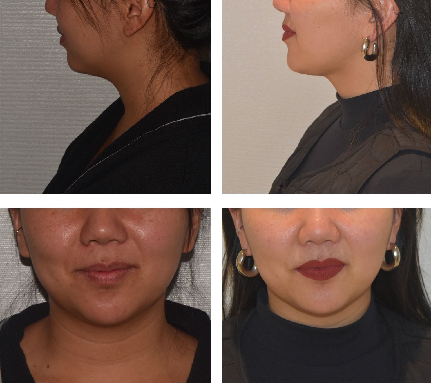 Split image shows two side and two front views of a woman's face before and after Chin Liposuction, highlighting changes in the chin and jawline areas.