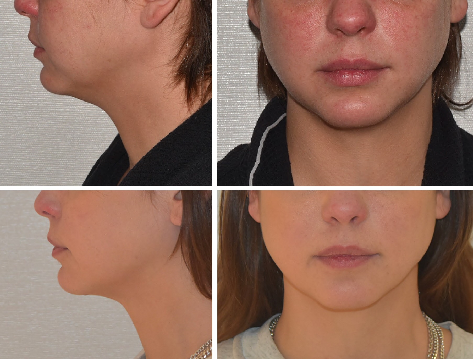 Four images showing chin liposuction before and after photos of a woman's lower face, neck, and jawline from side and front angles, highlighting changes in skin tone and contour.