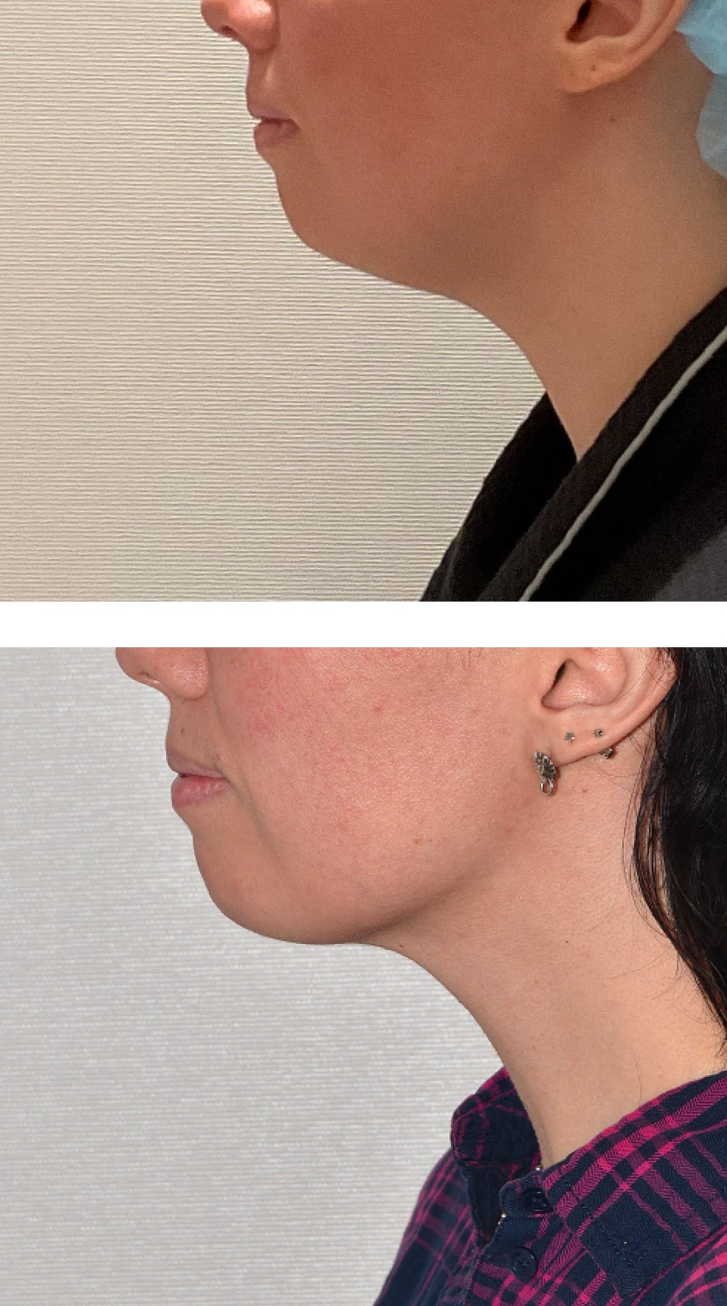 Side view before and after photos of a person who underwent chin lipo, highlighting a reduced double chin and a more defined jawline in the after image.