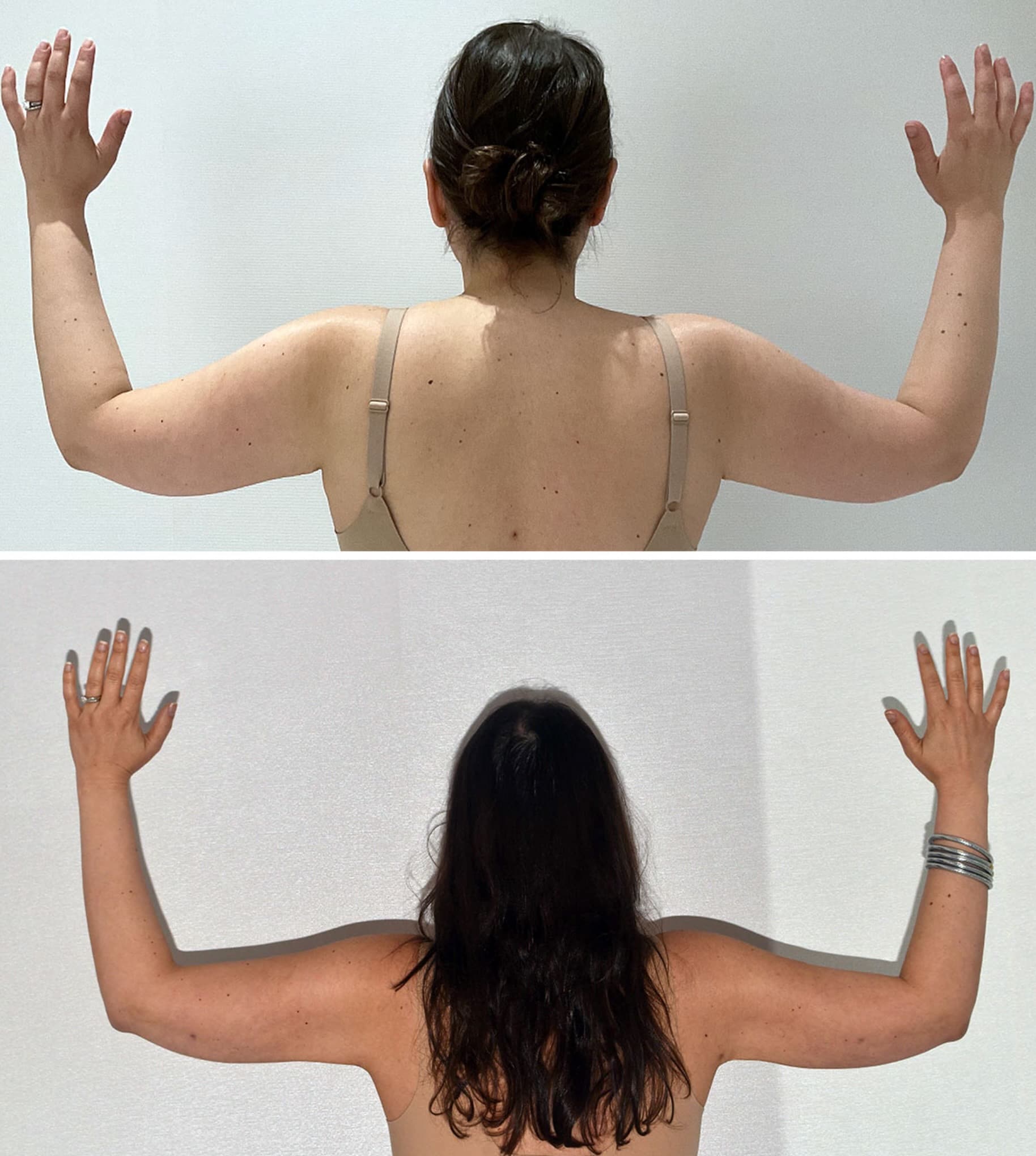 Two side-by-side images in this photo gallery show a woman from behind, arms raised. The top "Before" image has her hair up; the bottom "After" image, taken post-arm liposuction, shows her hair down and accessorized with bracelets.