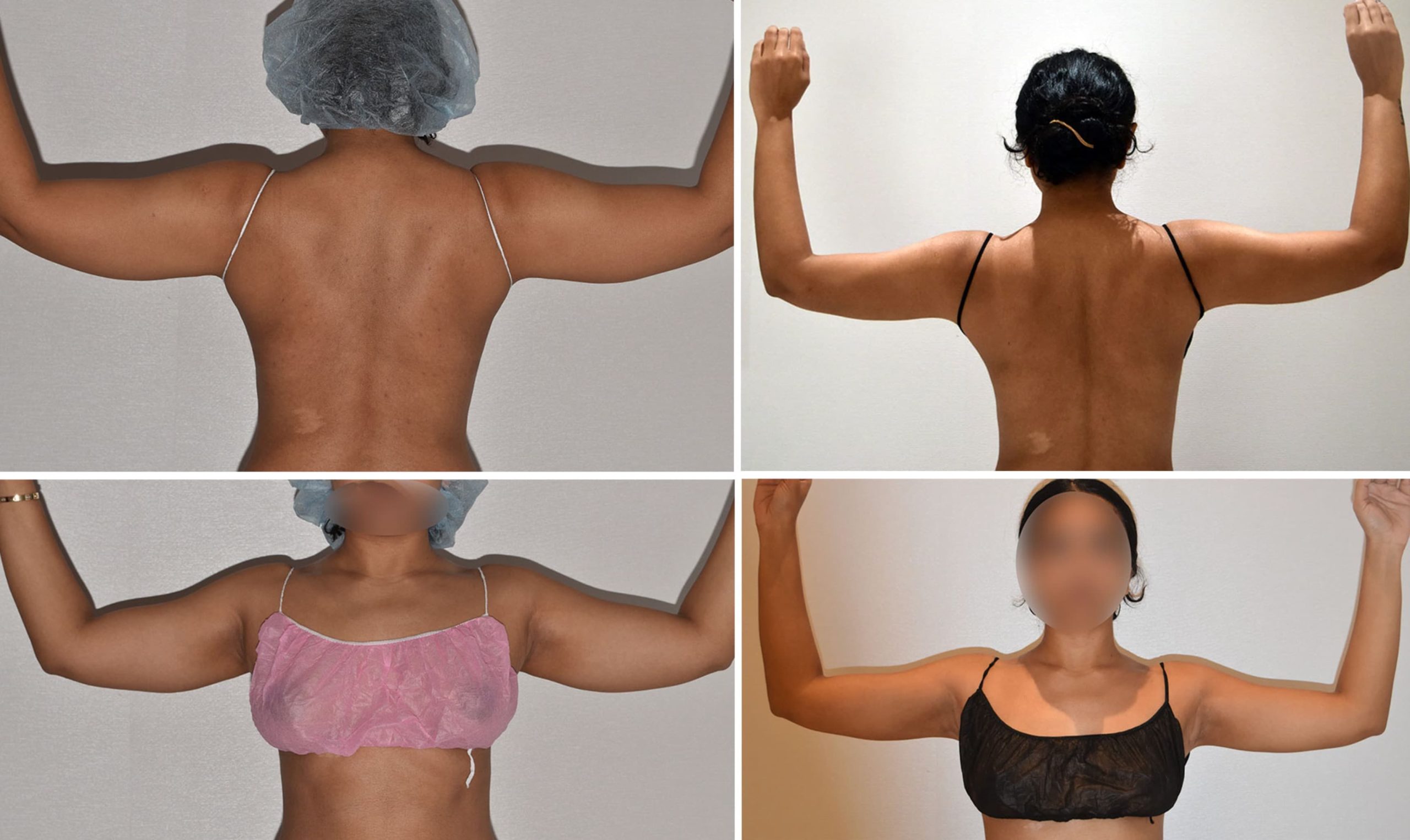 Four images from our Arm Liposuction Photo Gallery show a woman’s back and arms before and after the procedure, with arms raised; faces are blurred for privacy.
