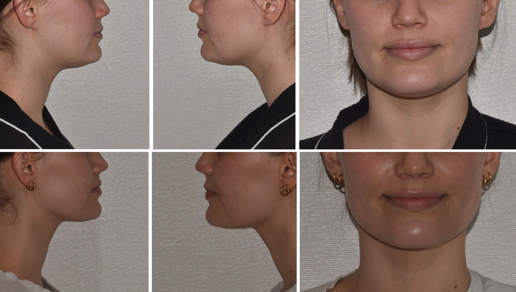 Before and after photos highlighting the transformation in chin and jawline appearance, featuring side and front profile views. See the difference Chin liposuction can make with these chin liposuction photos.