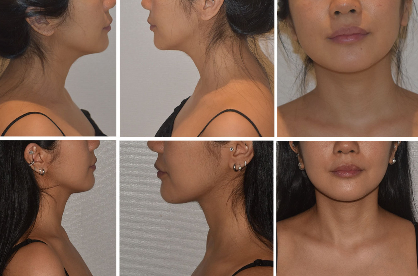 Before and after photos of a woman’s lower face and neck from side and front angles, highlighting improved jawline definition and contour following Chin Liposuction.