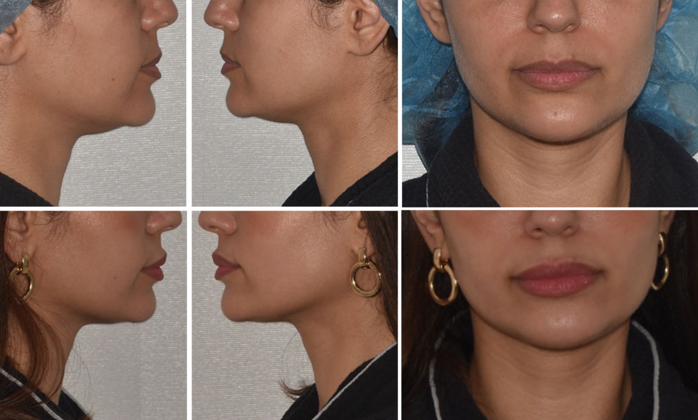 Six photos display before and after views of a woman's lower face, highlighting the noticeable transformation in her chin and lips following chin liposuction.