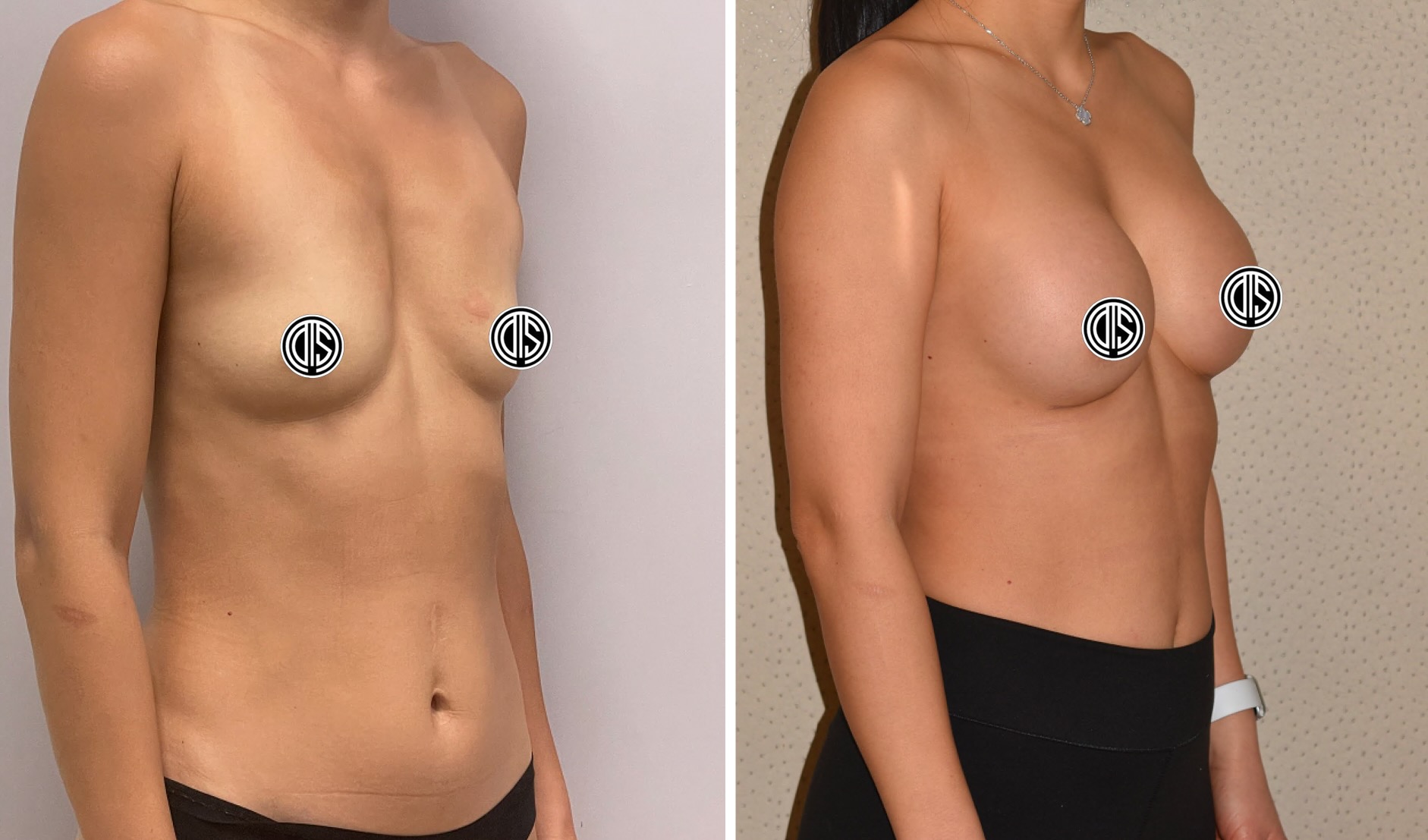 Side-by-side images display a woman’s torso before and after breast augmentation, highlighting the noticeable increase in breast size.