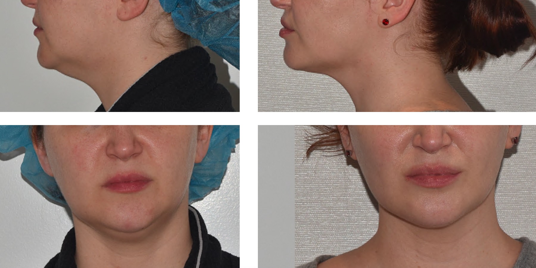 Before and After Photos showing a woman’s face and neck from front and side views, highlighting the transformation in jawline definition after Chin Liposuction.