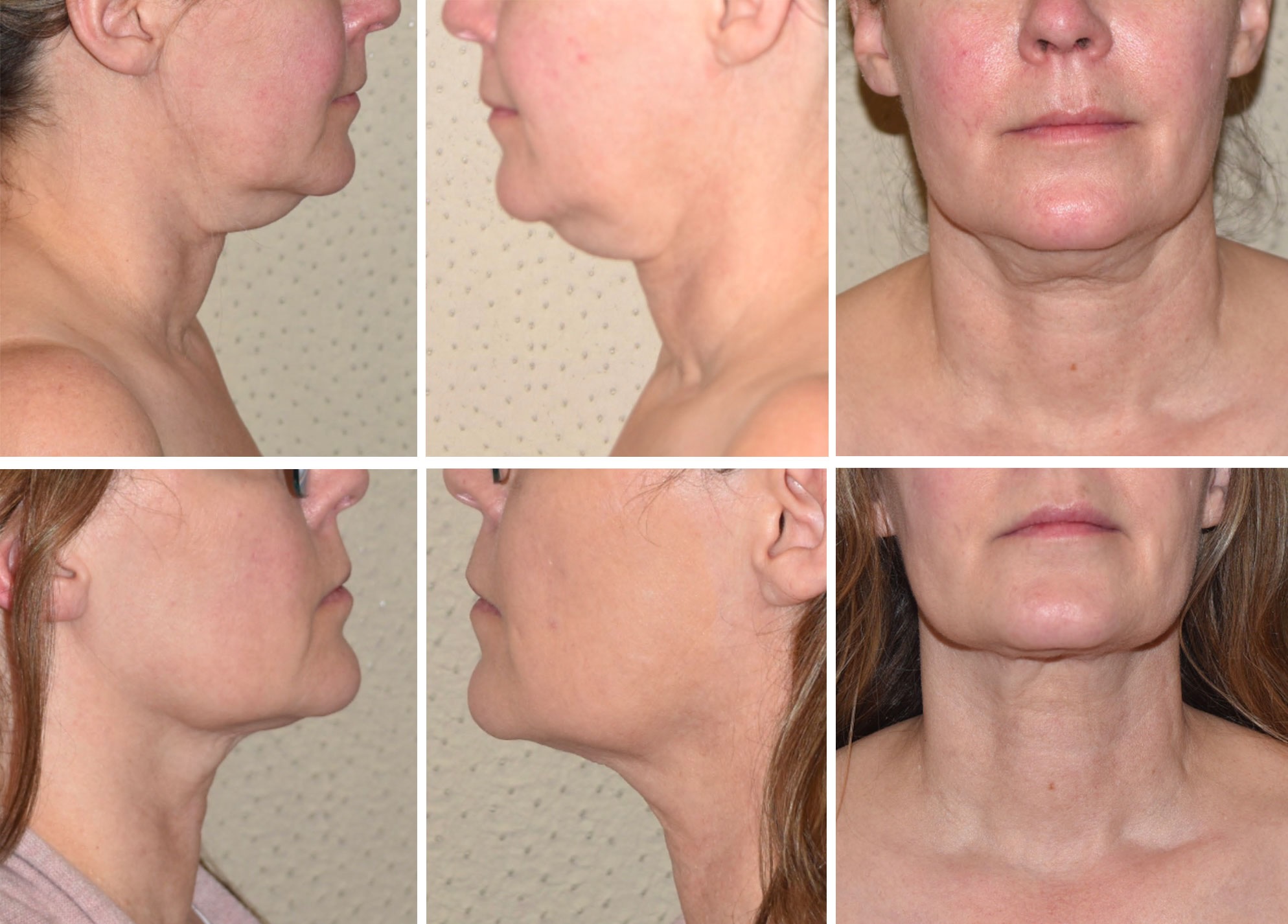 Before and after photos of a woman's lower face and neck from different angles, highlighting visible changes in jawline and chin appearance following chin liposuction.