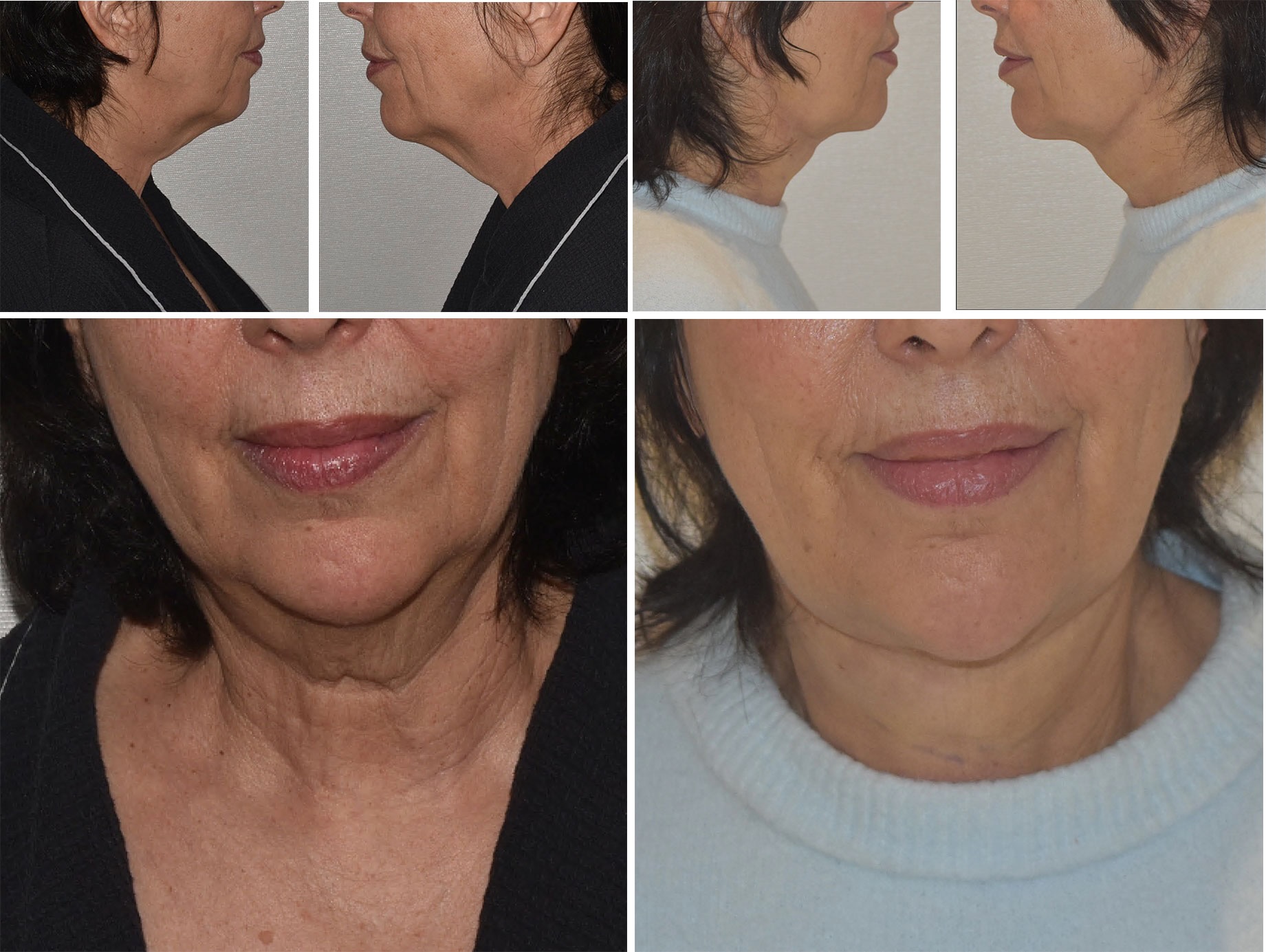 Side and front views of a middle-aged woman's lower face and neck, highlighting differences in skin tightness and appearance in Chin Liposuction before and after photos.