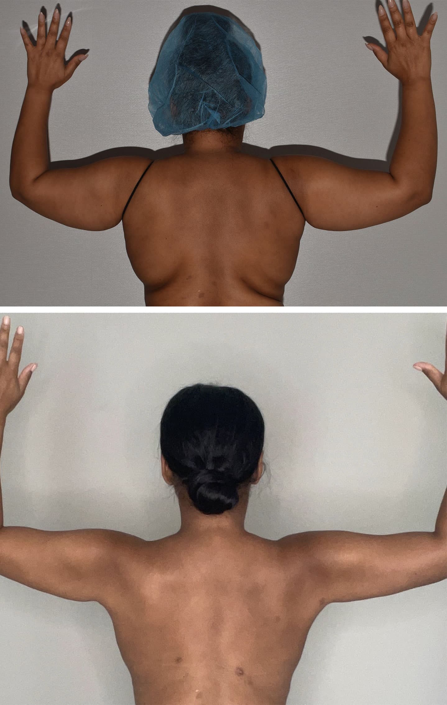 Two side-by-side photos from our Photo Gallery show a woman from behind with arms raised. The Before and After images highlight the slimming results of Arm Liposuction, along with her new hairstyle.