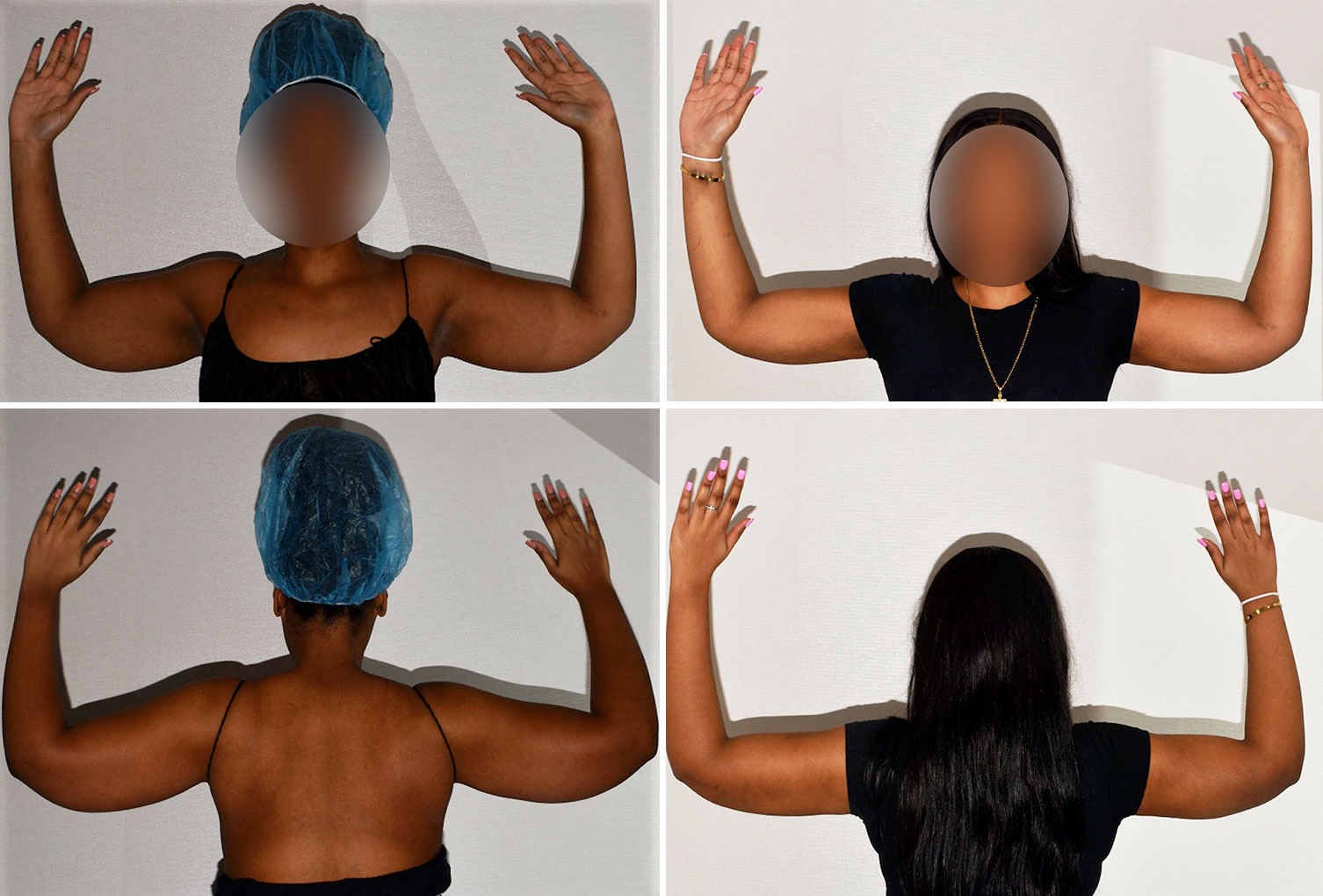 Photo Gallery: Four side-by-side photos show a person raising their arms before and after Arm Liposuction, viewed from front and back, with the face blurred and different hairstyles visible.