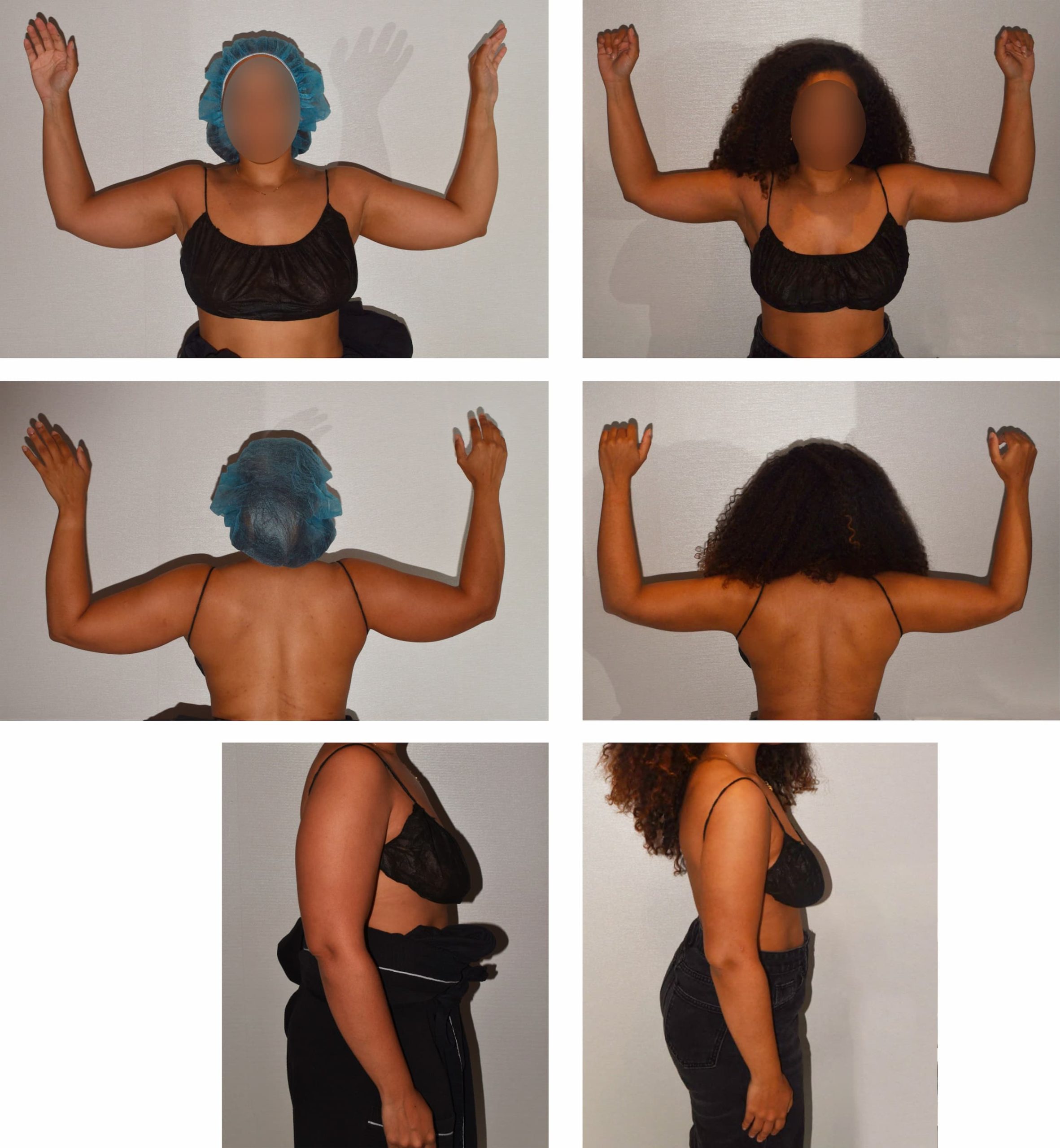 Woman shown from front, back, and side angles with arms raised or at sides; this arm liposuction photo gallery features before and after images that highlight changes in her arms and waist. Faces are blurred for privacy.
