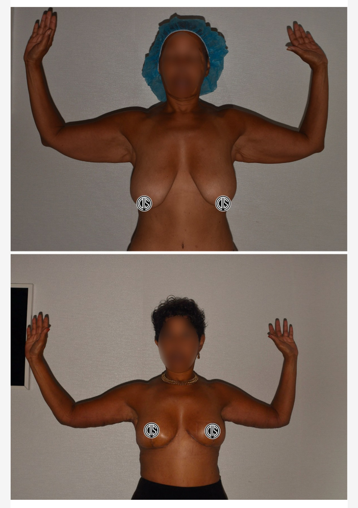 Two side-by-side Arm Lift photos of a woman with arms raised, showing a before and after comparison of a medical or cosmetic procedure on her breasts and arms.