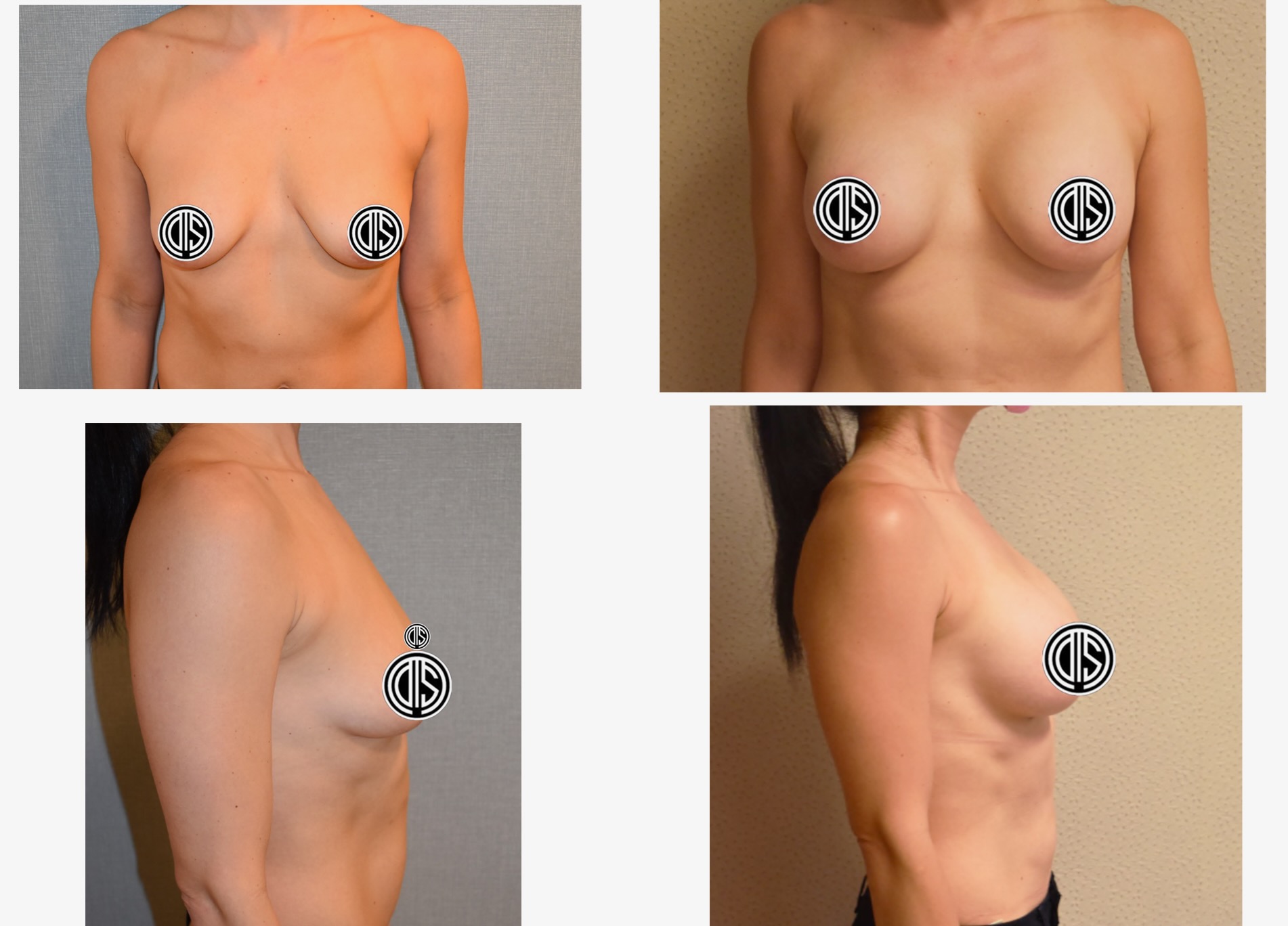 Before and after images of a woman's torso from front and side views highlight the changes following breast augmentation. Sensitive areas are covered by graphic icons.