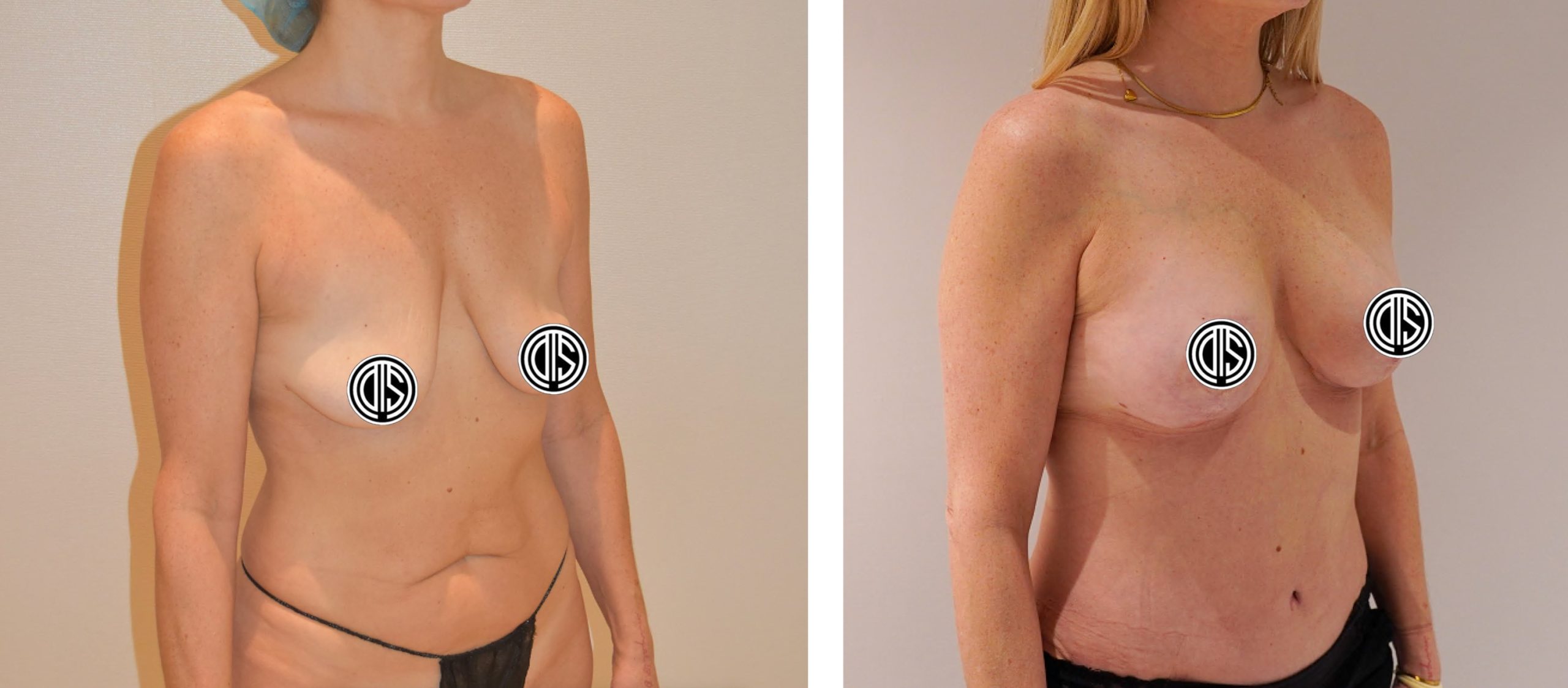 Before and After Photos of a woman highlighting surgical enhancement of breasts and abdomen; the left image shows her pre-surgery, while the right displays impressive Breast Lift results post-surgery.