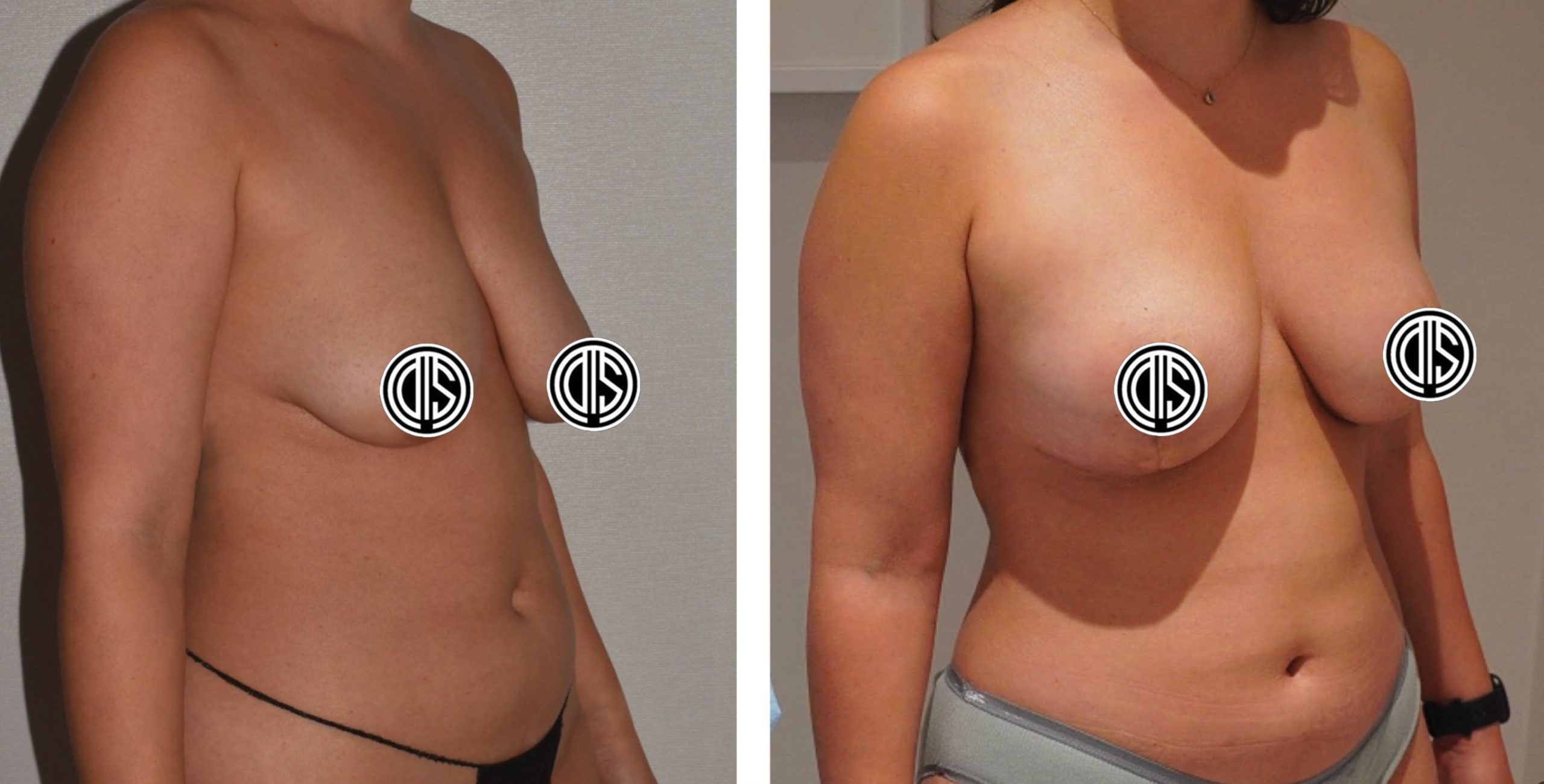 Two side-by-side breast lift photos show a woman's torso before and after the procedure, highlighting changes in breast shape and abdominal contour.