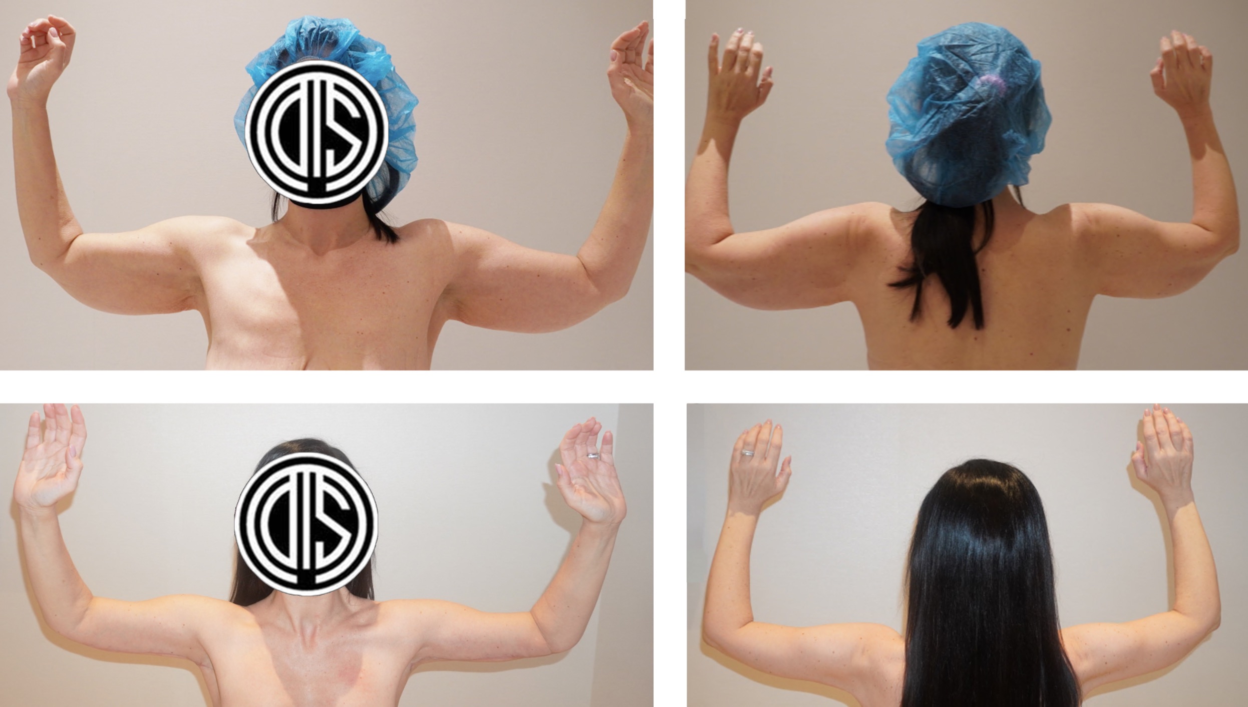 Four side-by-side Before and After photos of a woman raising her arms, highlighting changes in upper arm appearance after an Arm Lift, with her face obscured.