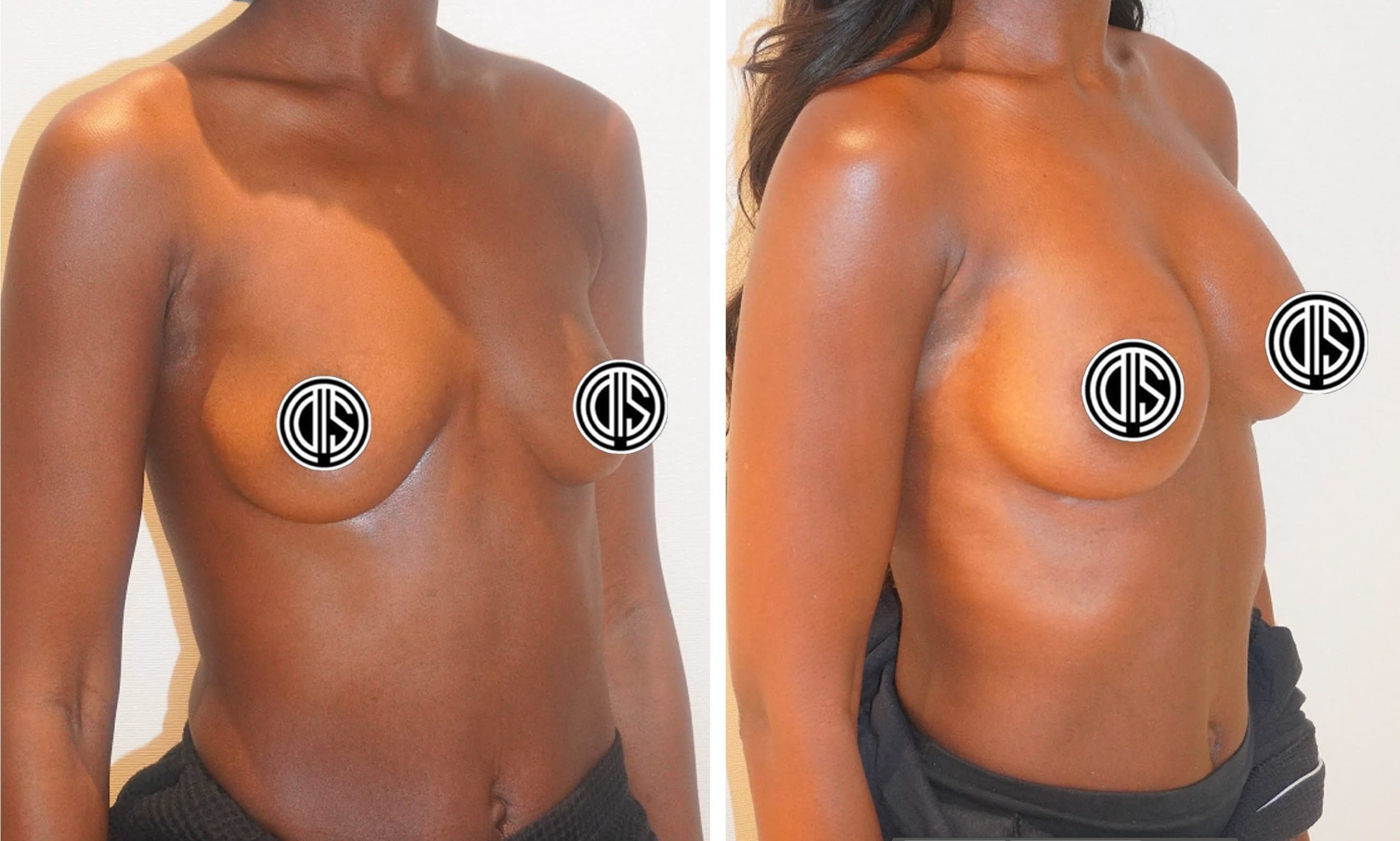 Before and after images of a woman’s torso highlight the results of breast augmentation surgery, with nipples covered for privacy.