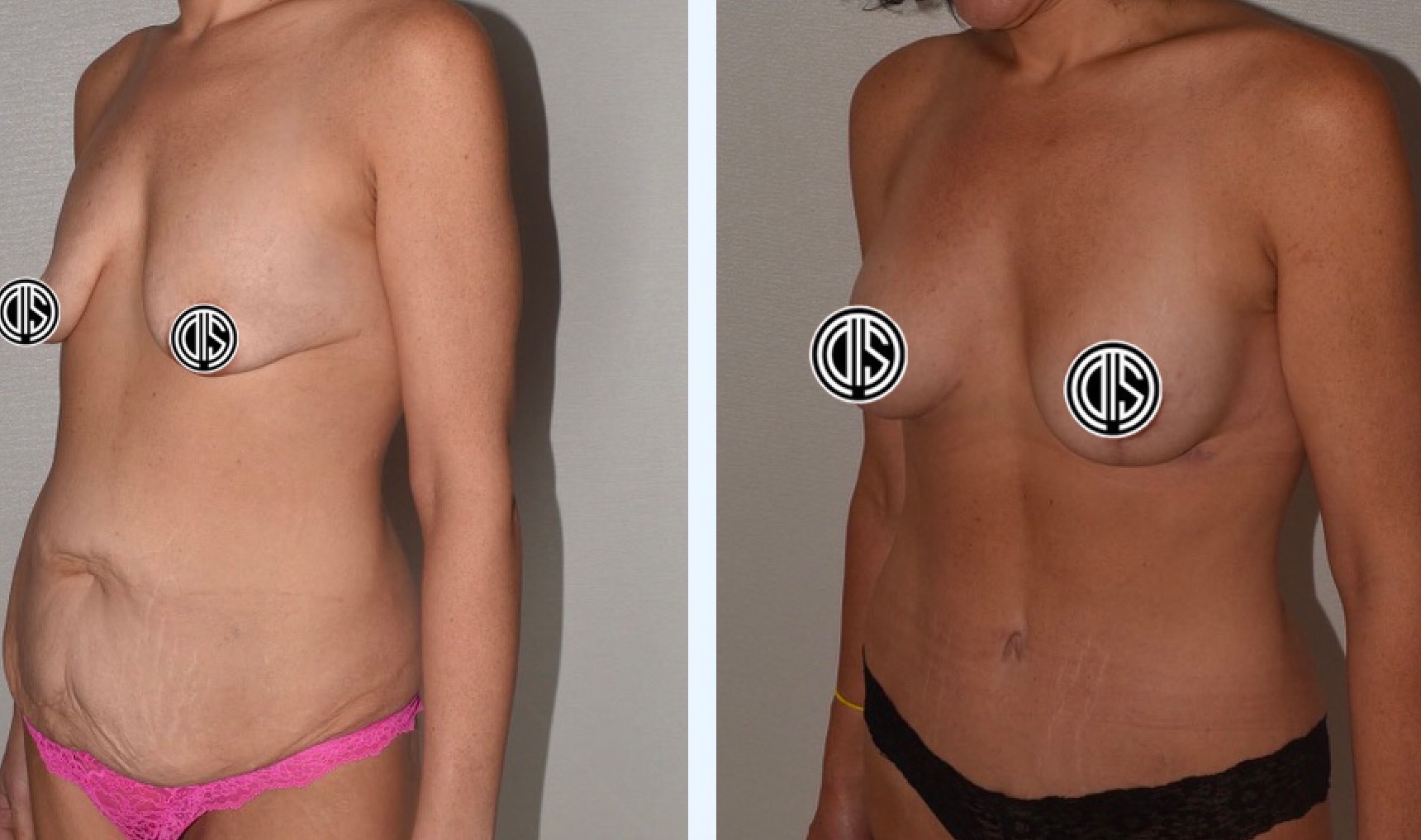 Side-by-side Before and After Photos of a woman; left shows loose abdominal skin and smaller breasts, while right highlights a tighter abdomen and enhanced breast shape following a Breast Lift.