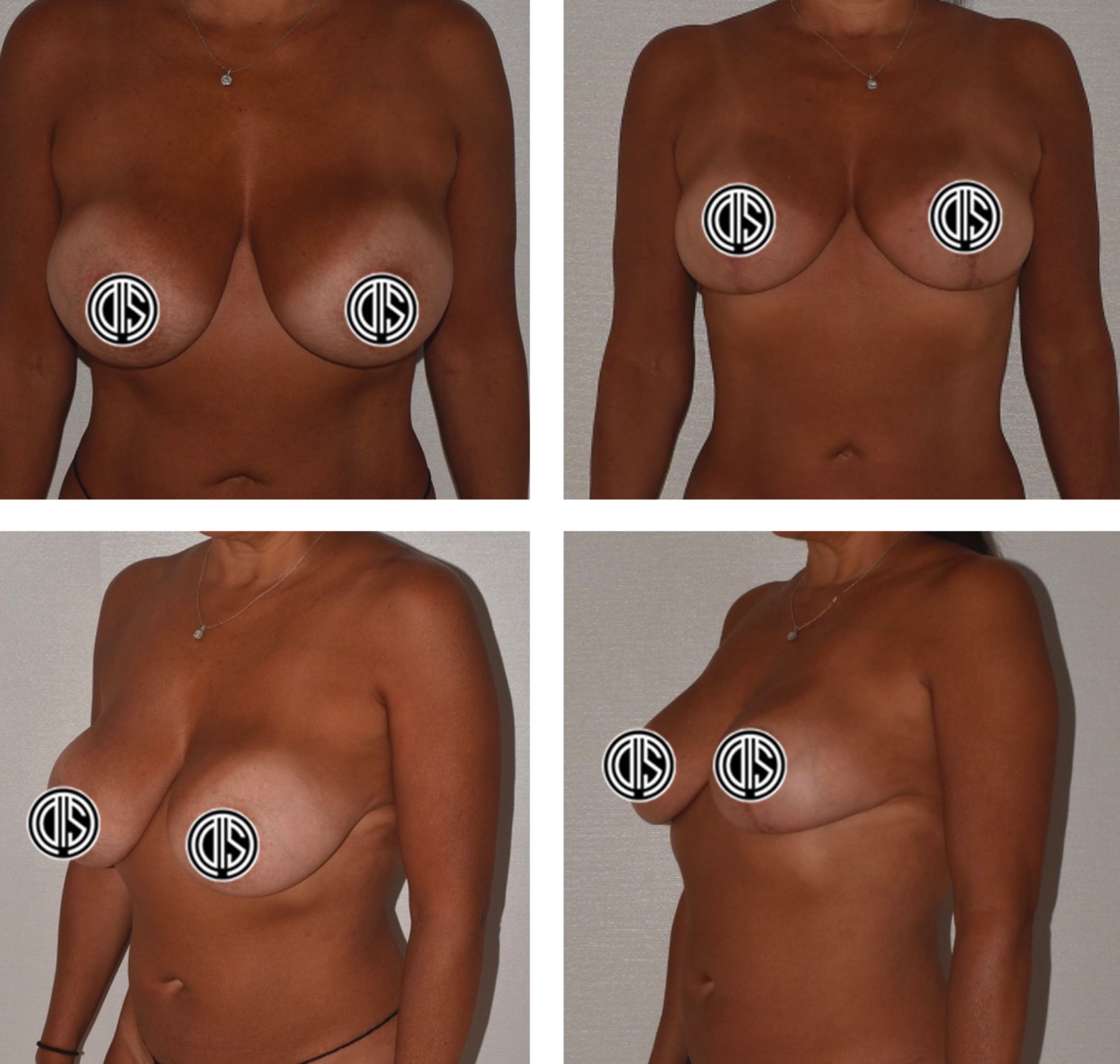 A collage of a woman's breasts featuring Breast Lift before and after photos.