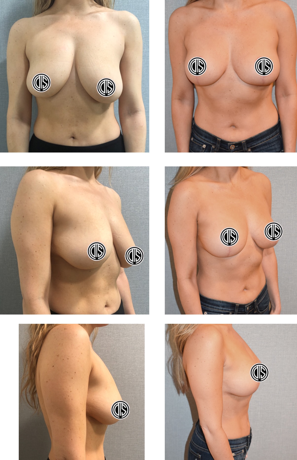 Before-and-after photos showing a woman from the front and side, with visible changes in breast size and shape after surgery. Nipples are censored for privacy. These Breast Lift Photos highlight the transformation.