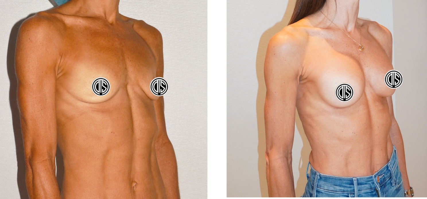 Before and after images display a woman's upper body following breast augmentation surgery, with her nipples covered by circles for modesty.