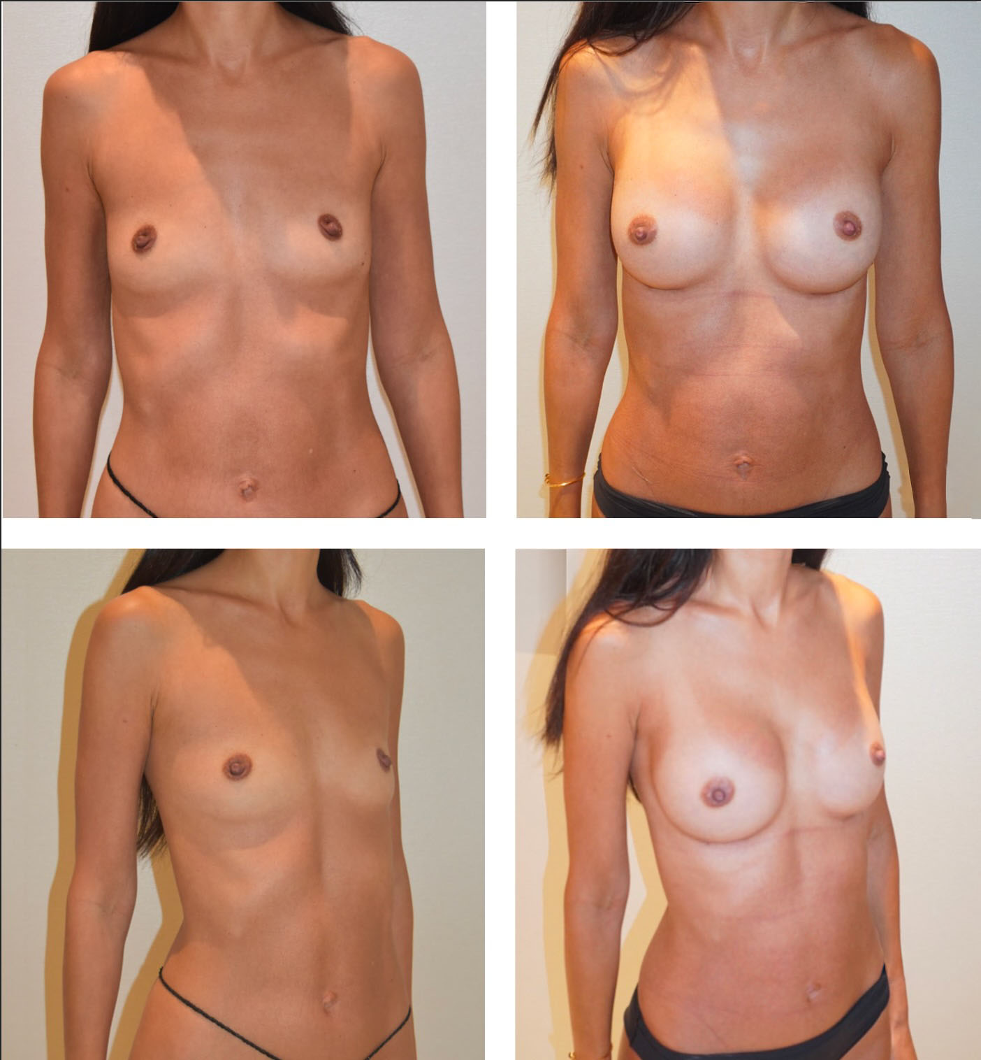 Four-panel images display a woman’s torso before and after breast augmentation surgery, with views from the front and at an angle.