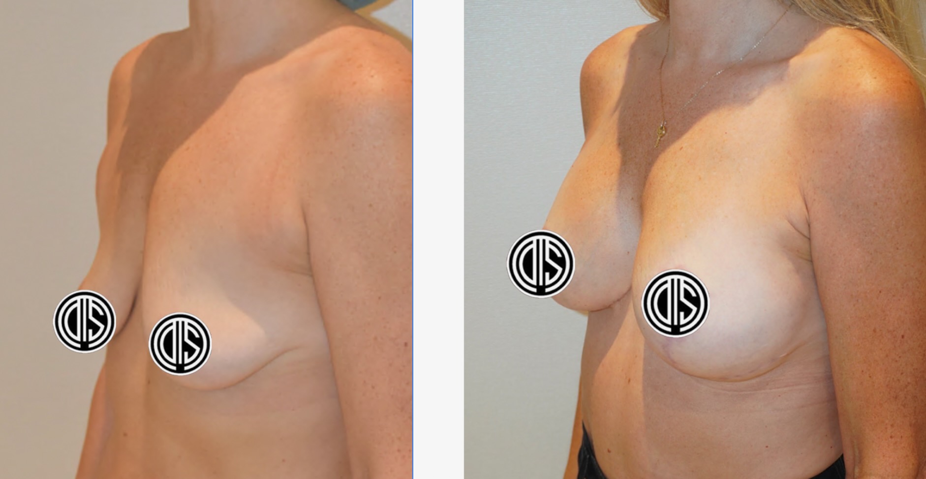Side-by-side comparison of a woman’s chest before (left) and after (right) breast augmentation, similar to Breast Lift Photos, with nipples covered by graphic icons for modesty.