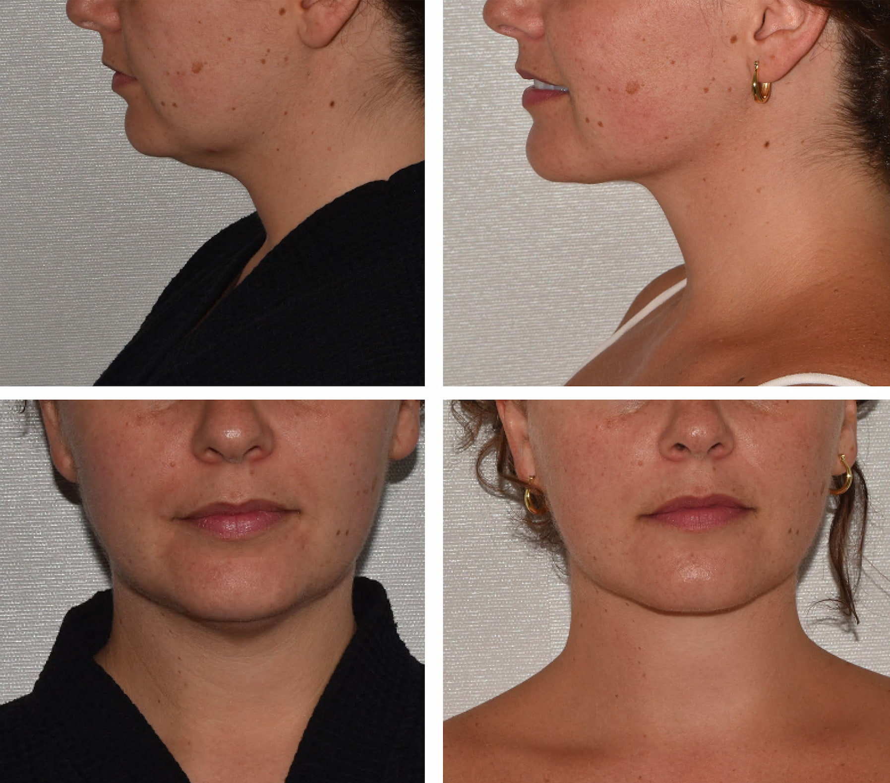 Four close-up before and after photos show a woman's lower face and neck from side and front views, highlighting the noticeable reduction in submental fullness following chin liposuction.