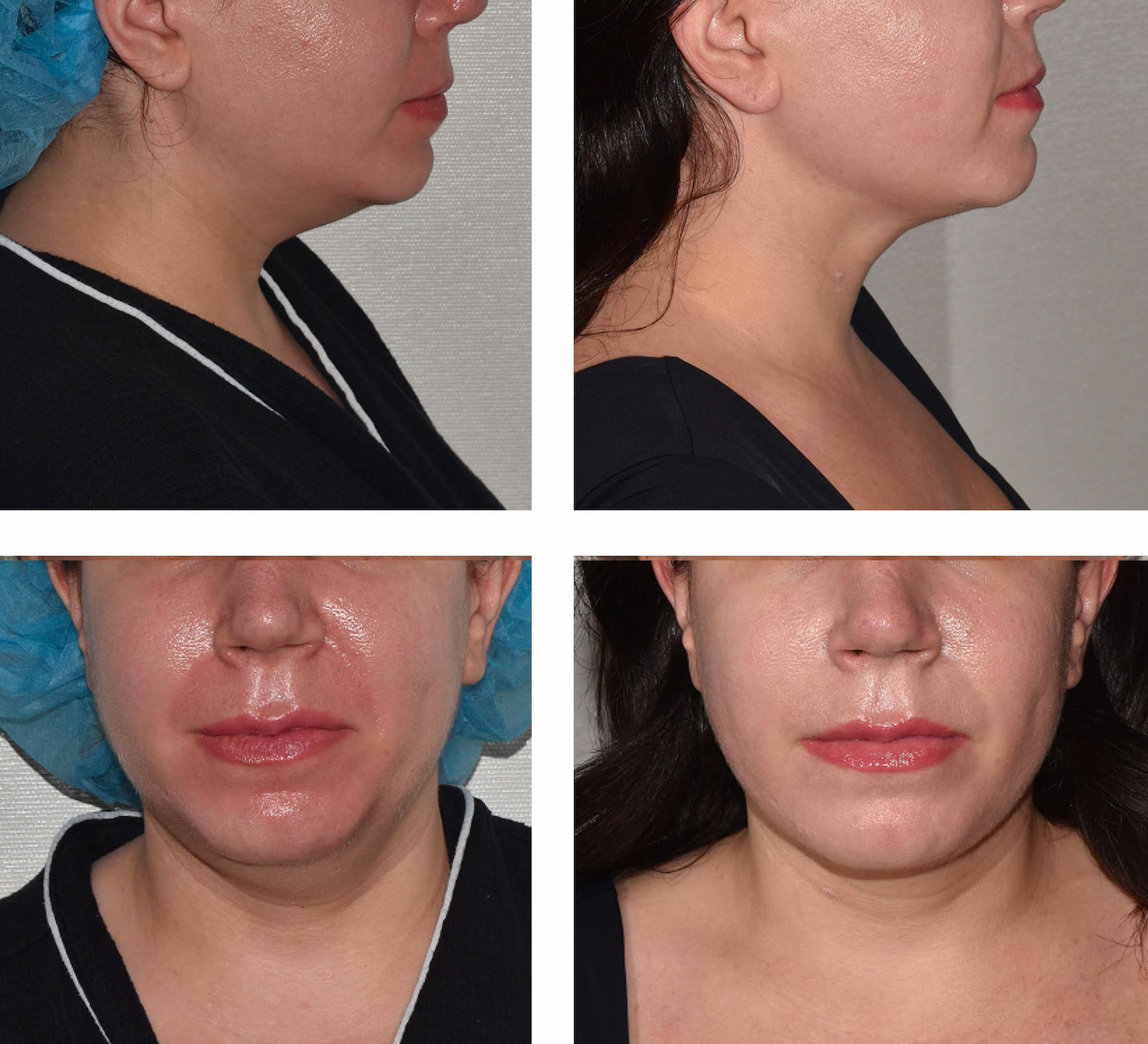 Four before and after photos showing a woman’s face from side and front views, highlighting changes in jawline and facial appearance following chin liposuction.