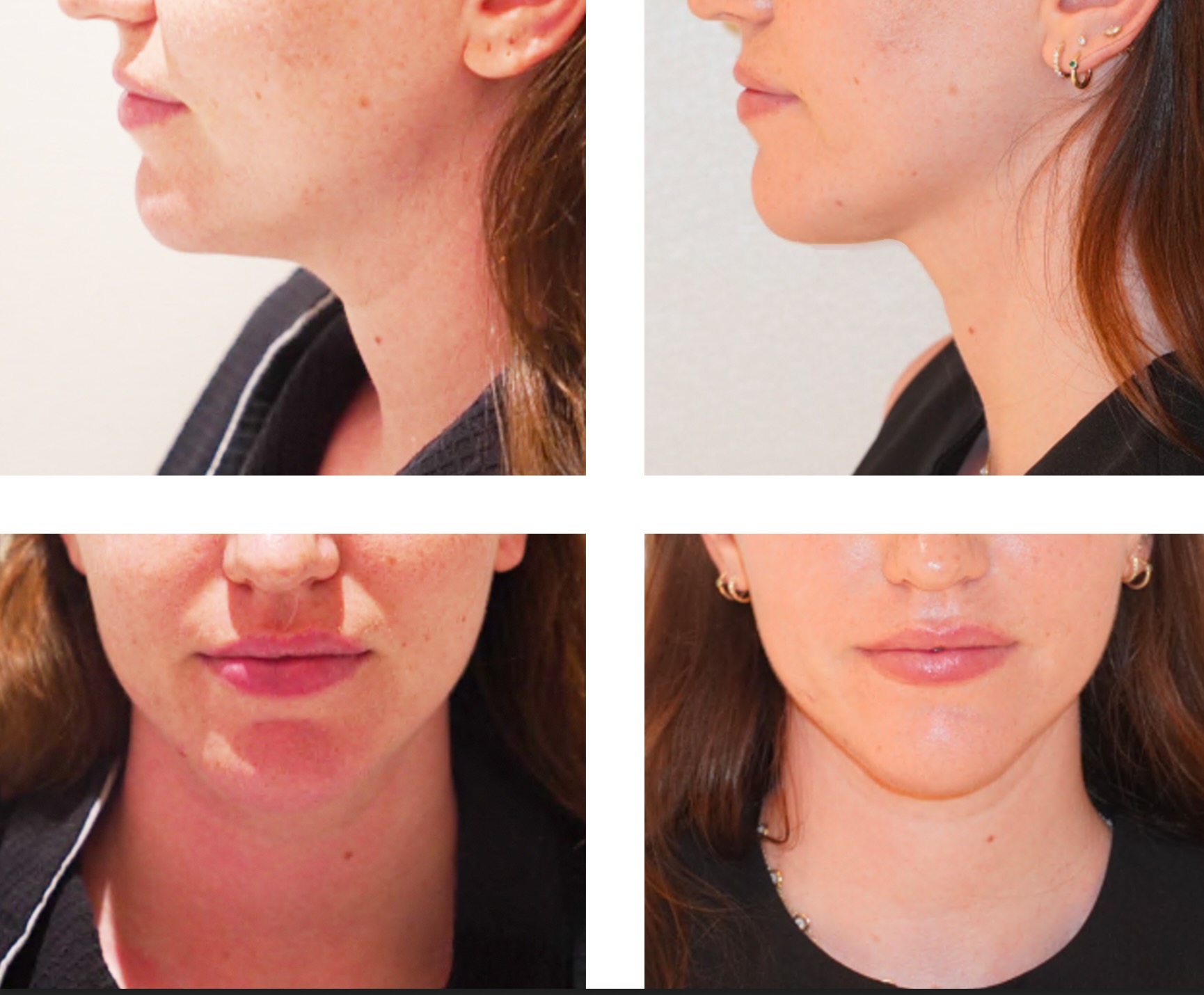 Four close-up images show a woman's lower face and neck from different angles, highlighting the jawline and chin area. These before and after photos illustrate the results of Chin Liposuction.