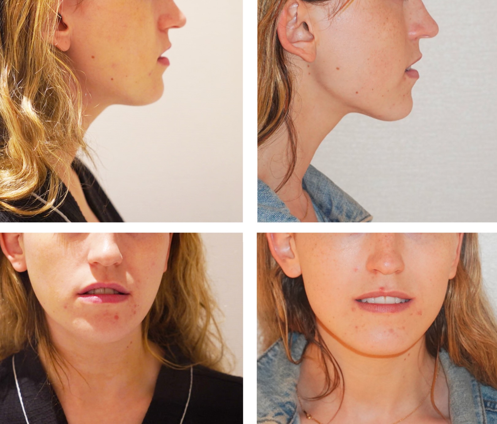 Four close-up images showing the left profile and front view of a woman's face before and after chin liposuction, highlighting differences in her jawline and chin. These before and after photos showcase noticeable chin liposuction results.
