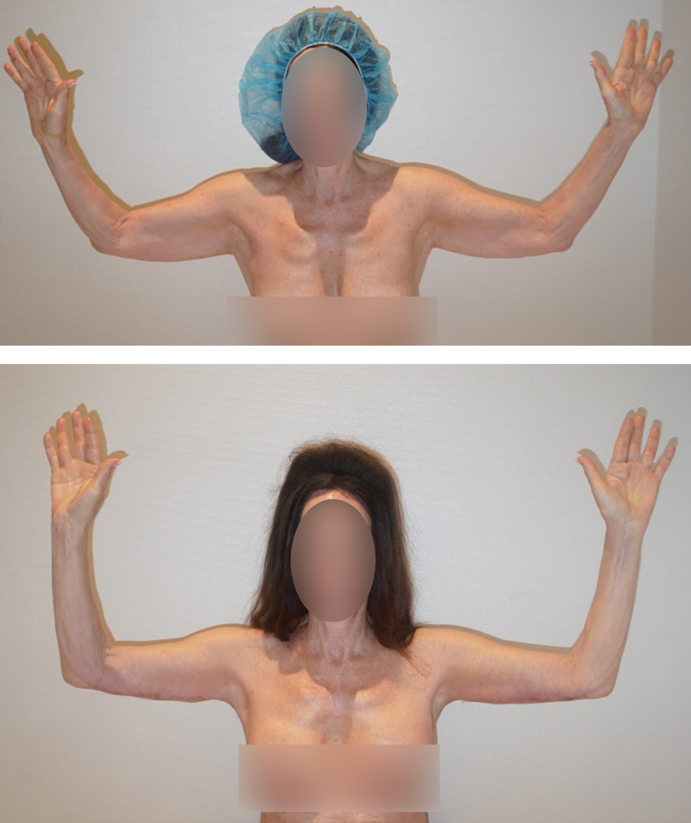 Two comparison photos showing a person with raised arms: the top image shows the person with a surgical cap, and the bottom image shows the person with long hair and no cap, illustrating Arm Lift before and after photos.