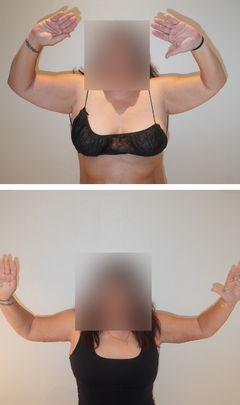 Two side-by-side Arm Lift photos show a person with arms raised in a before-and-after comparison of upper arm appearance, with face blurred for privacy.