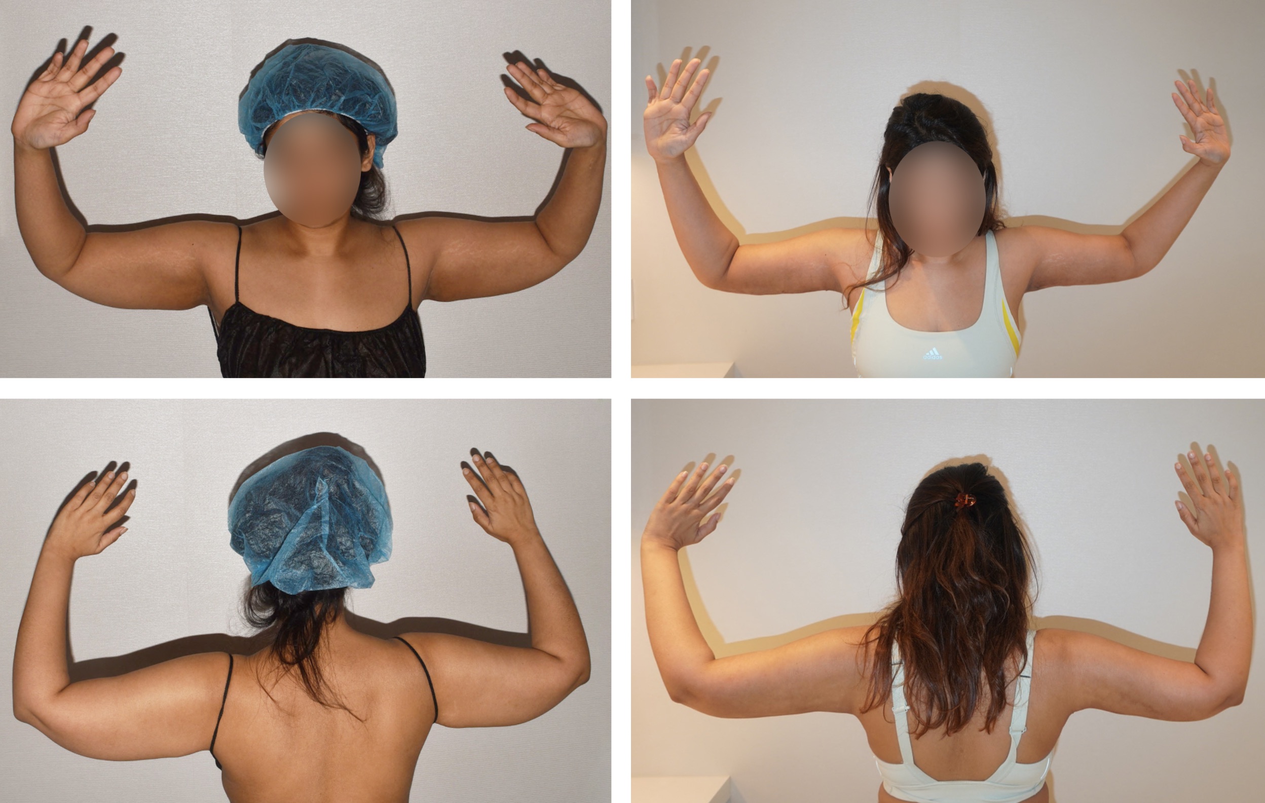 Four Arm Lift before and after photos show a woman from the back with arms raised; her face is blurred for privacy. The top row shows before, while the bottom row displays Arm Lift results after the procedure.