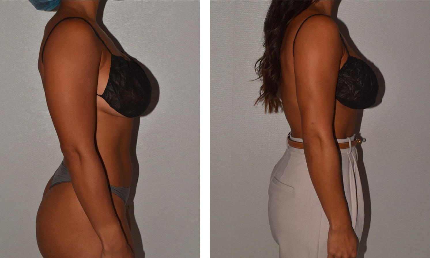 Side-by-side comparison of a woman before and after arm liposuction, wearing different clothing in each image—an inspiring addition to any before and after photo gallery.