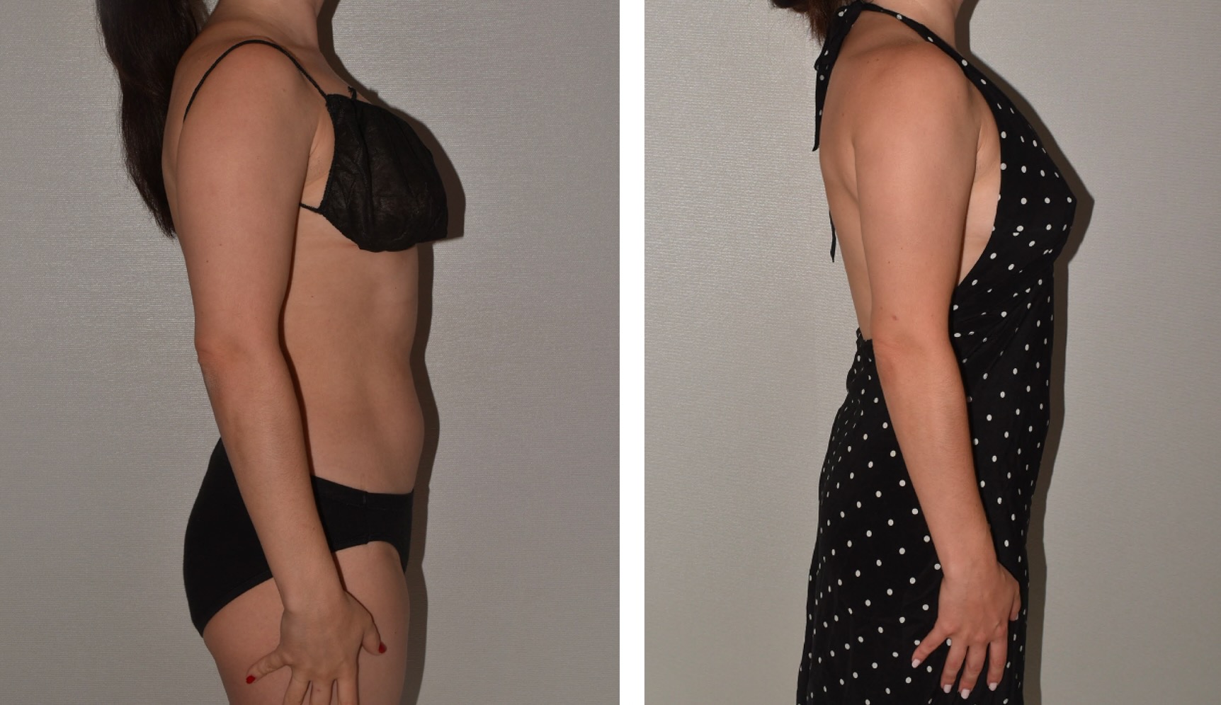 Side-by-side photos in this Before and After photo gallery show a woman in black underwear before and a black dress with white dots after, highlighting the visible change in body shape following arm liposuction.