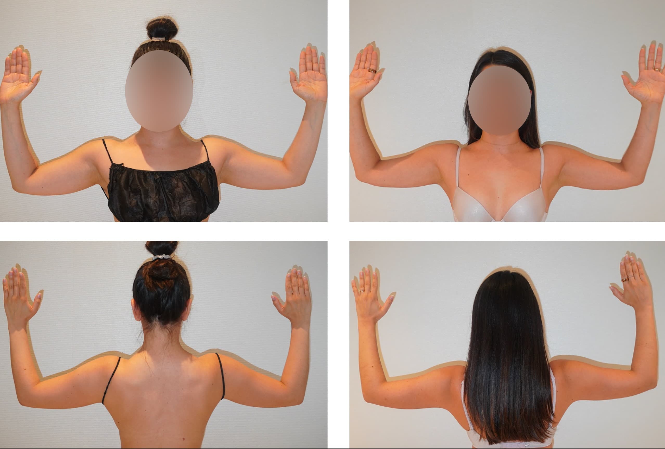 Four side-by-side photos in this Photo Gallery show a woman with her back to the camera and arms raised, highlighting Before and After results of arm liposuction; her face appears blurred in each image.