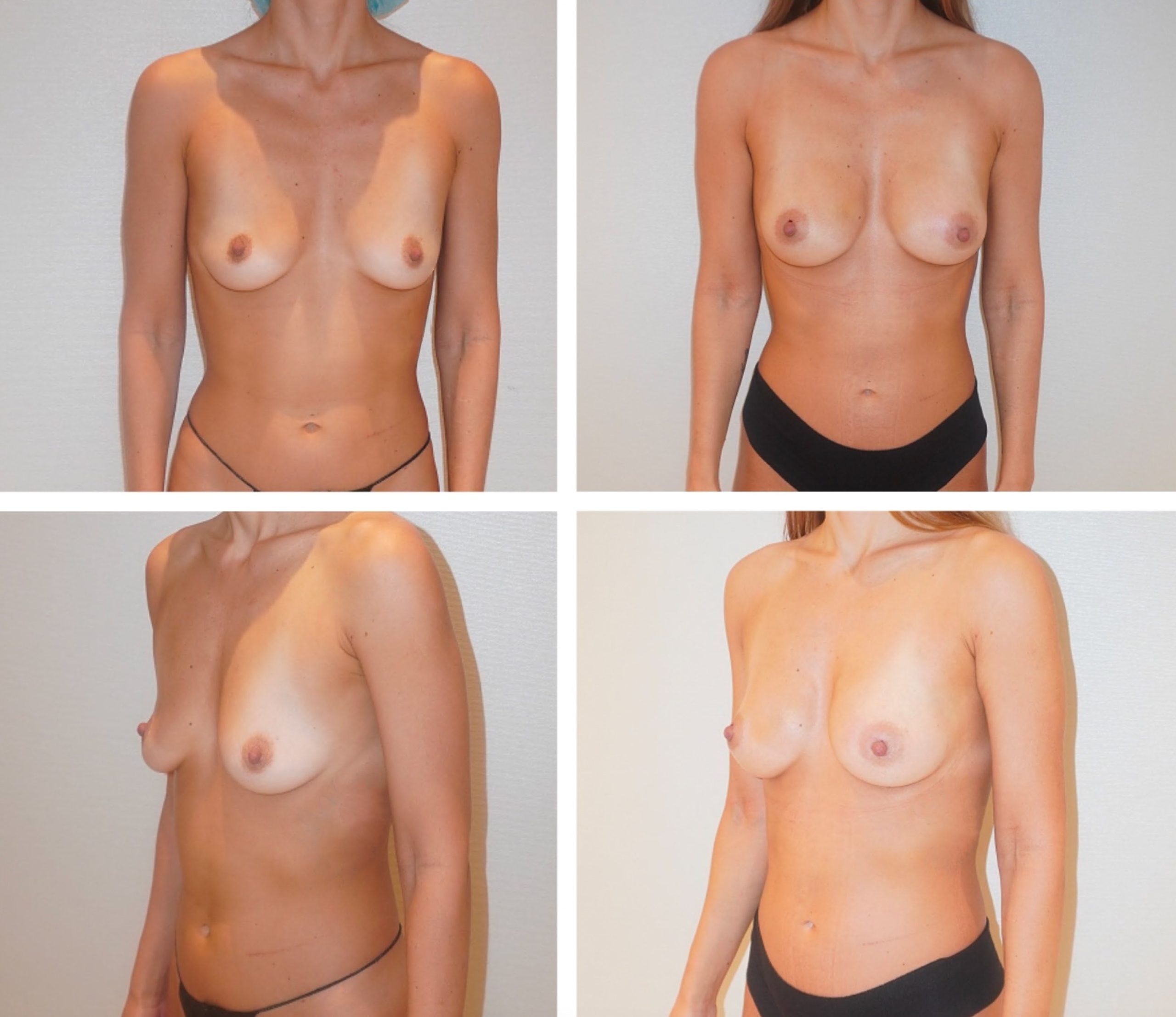 Four side-by-side breast augmentation images show a woman from the waist up, with before and after images (bottom and top rows) viewed from different angles.