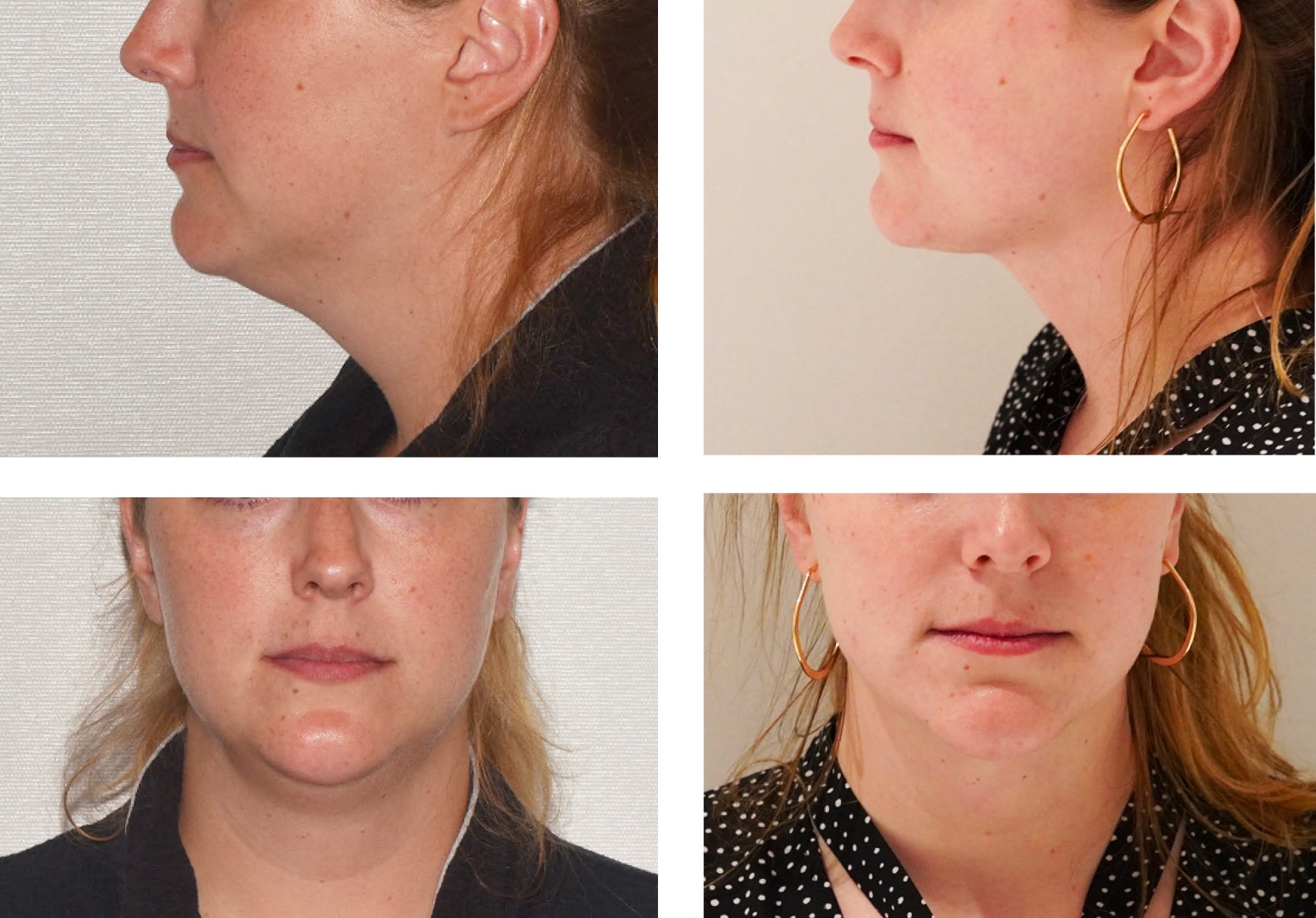 Before and After photos show a woman’s lower face and neck from side and front angles, highlighting the results of chin liposuction with reduced submental fullness and a more defined jawline in the after images.